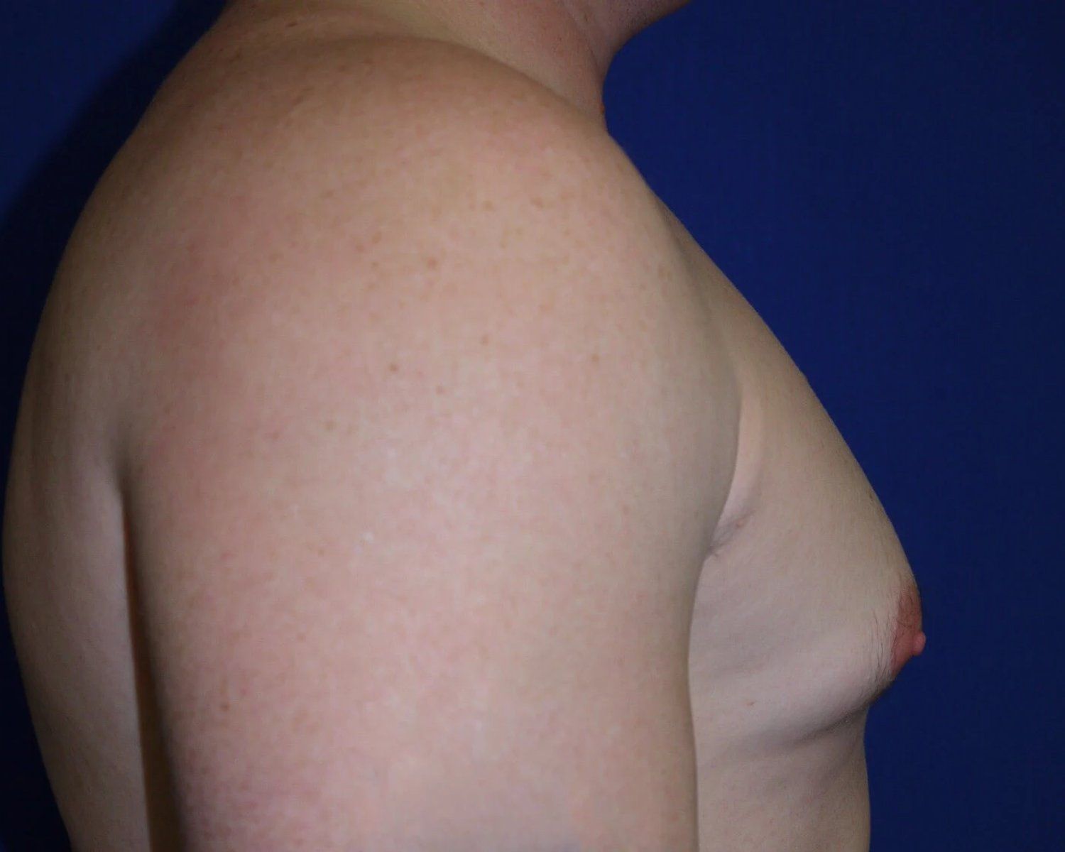 One-Stitch Gynecomastia — Oblique Right view, before