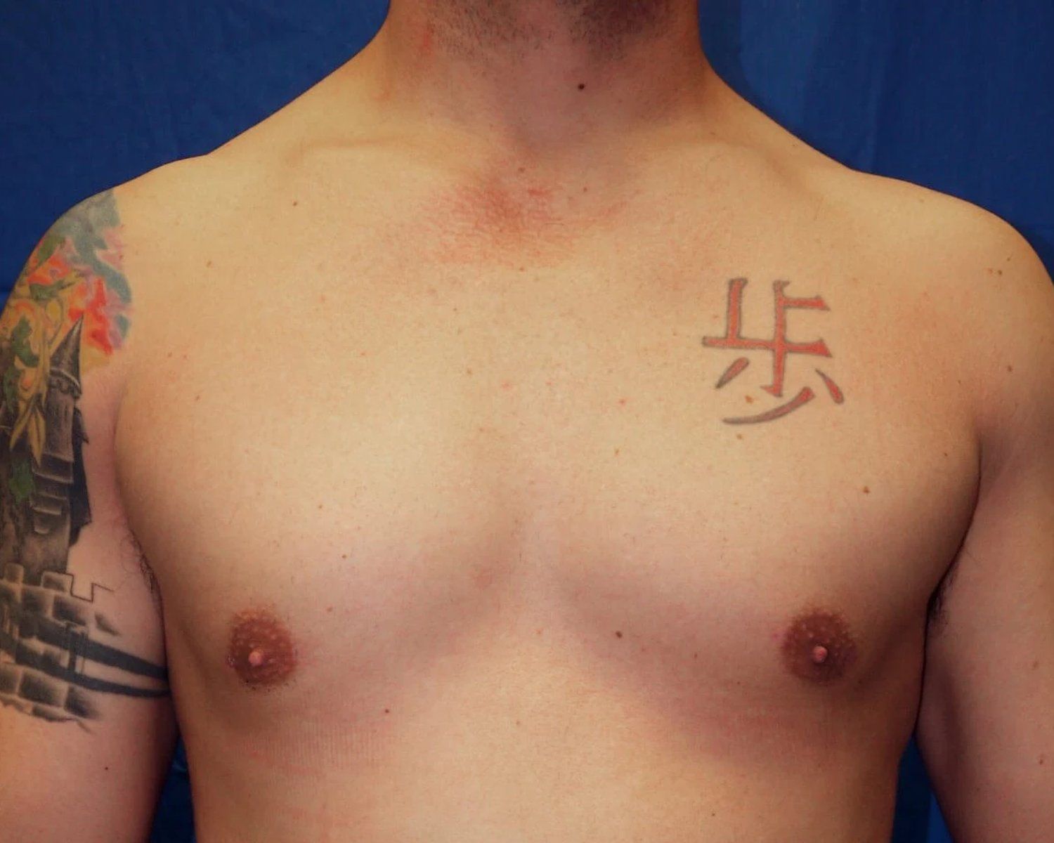 One-Stitch Gynecomastia after