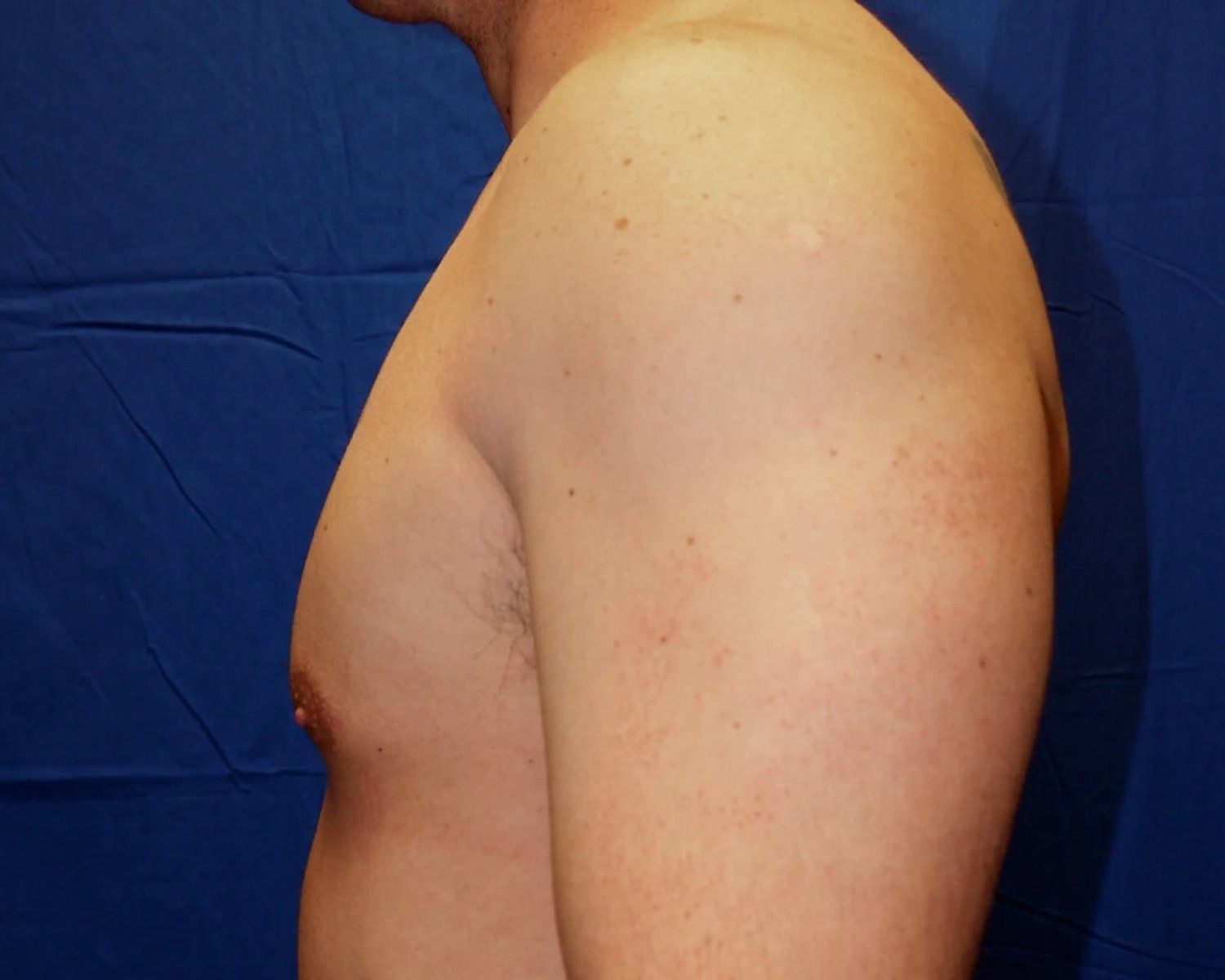 One-Stitch Gynecomastia — Oblique Left view, after