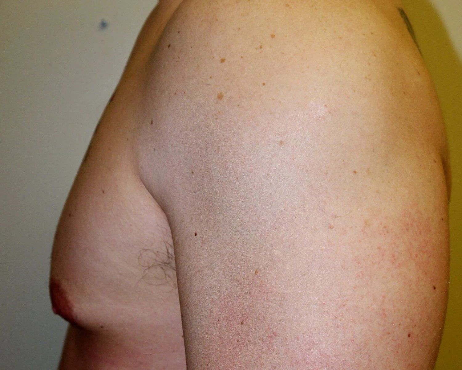 One-Stitch Gynecomastia — Oblique Left view, before