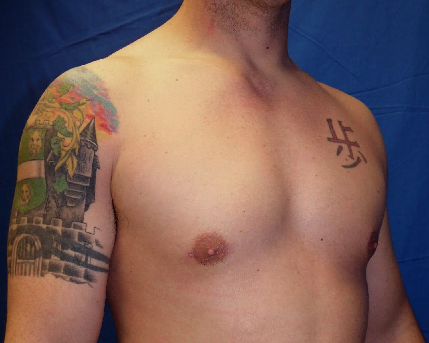 One-Stitch Gynecomastia — Oblique Right view, after