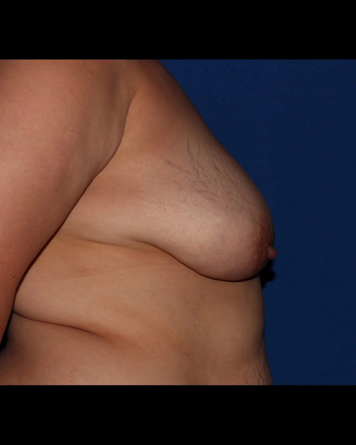 Fat Transfer To the Breast, Right Profile view, before