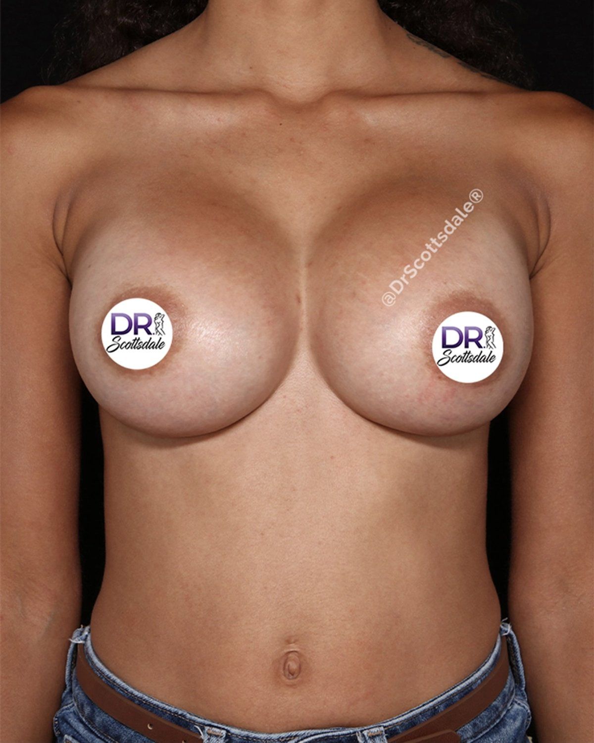 Breast Augmentation with Implants after