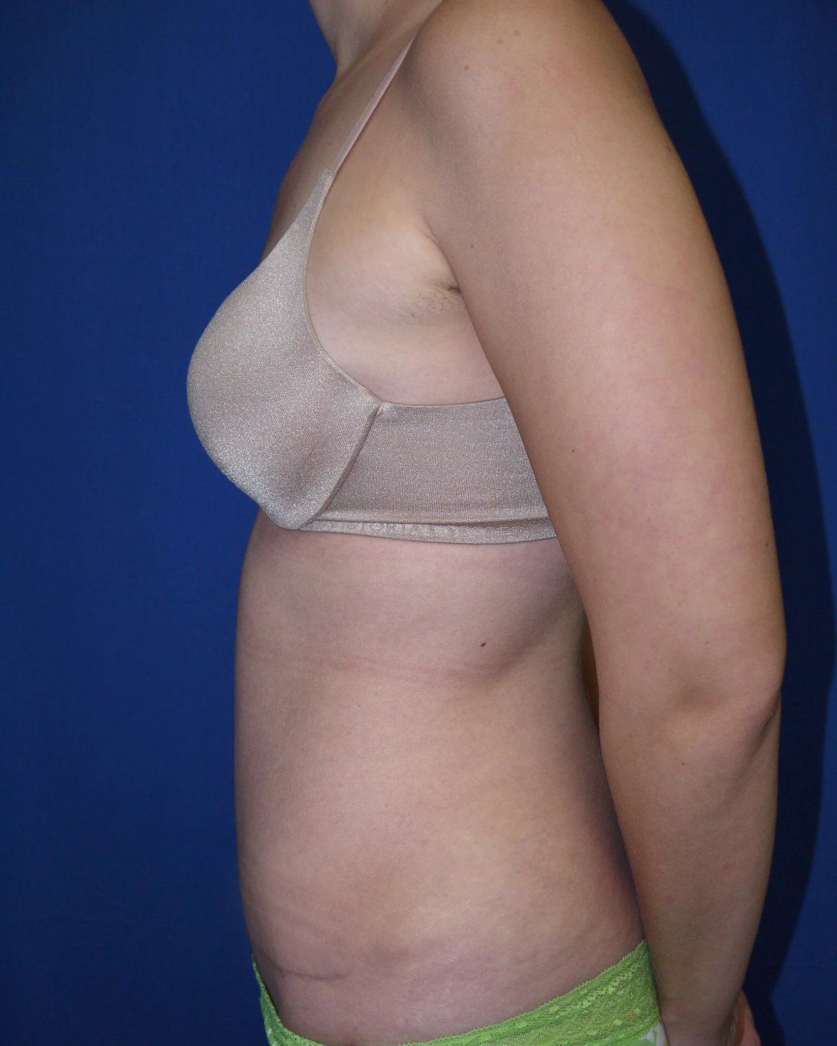 Tummy Tuck — Oblique Right view, after