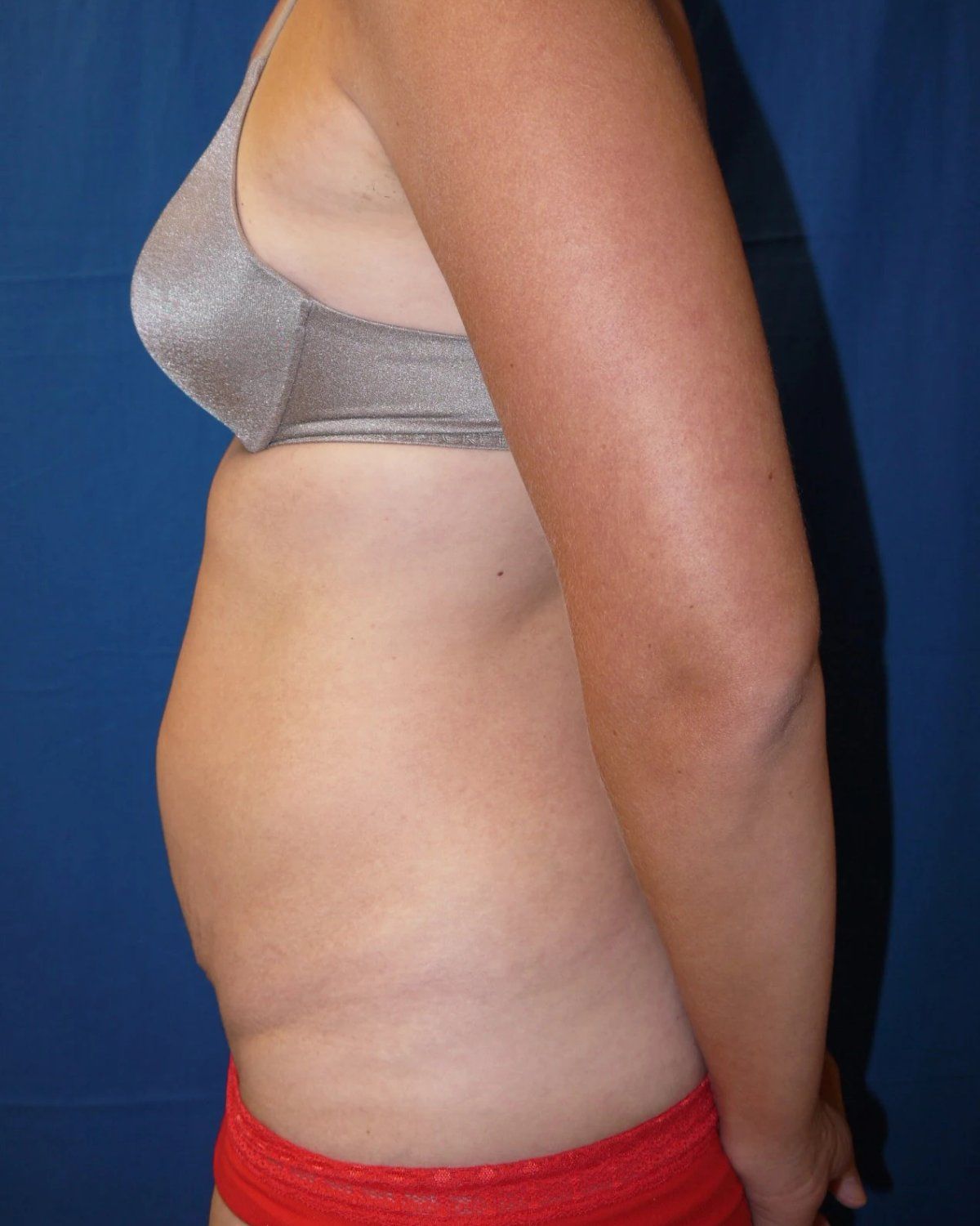 Tummy Tuck — Oblique Right view, before