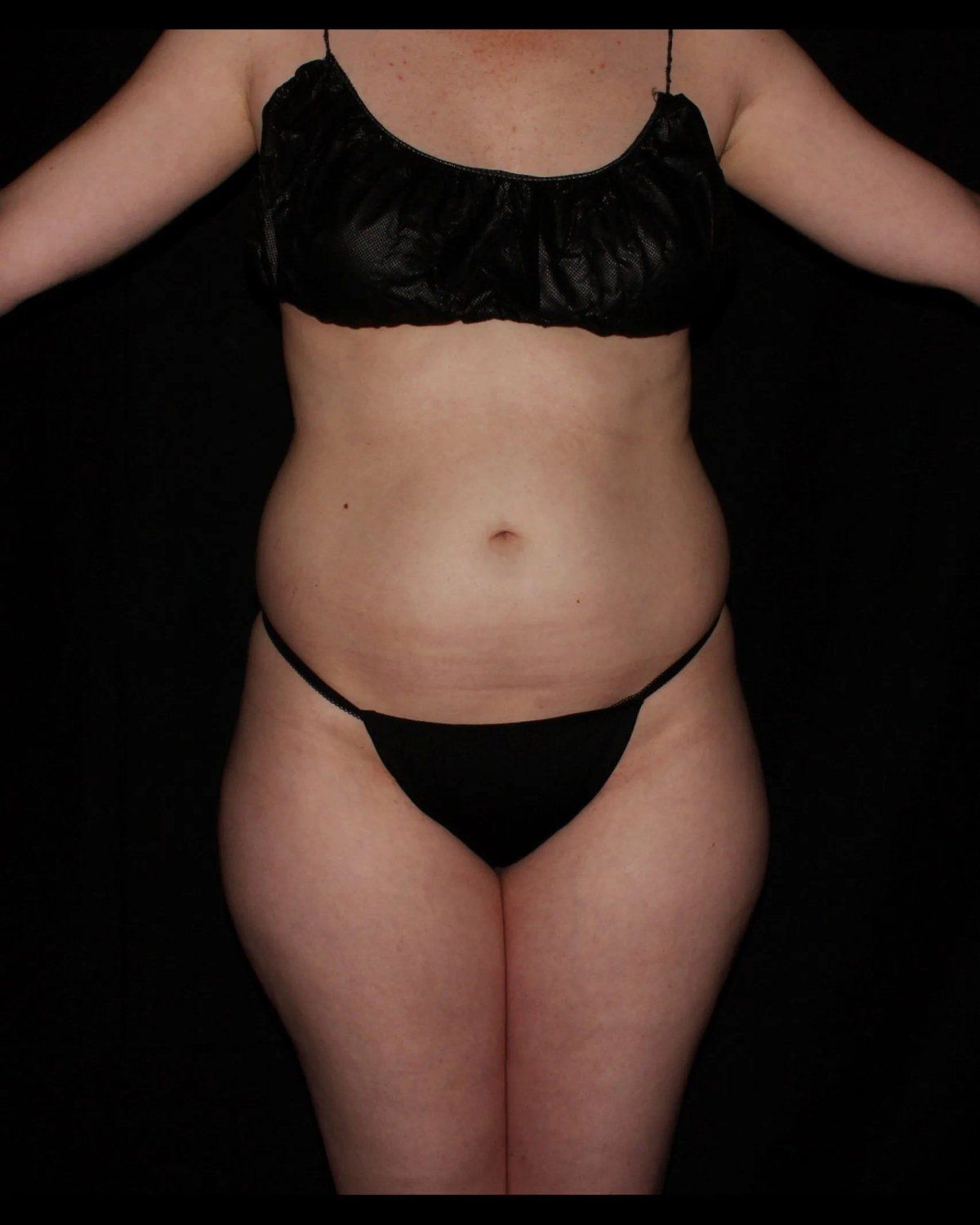 Vaser Lipo 360 (5L Max) before