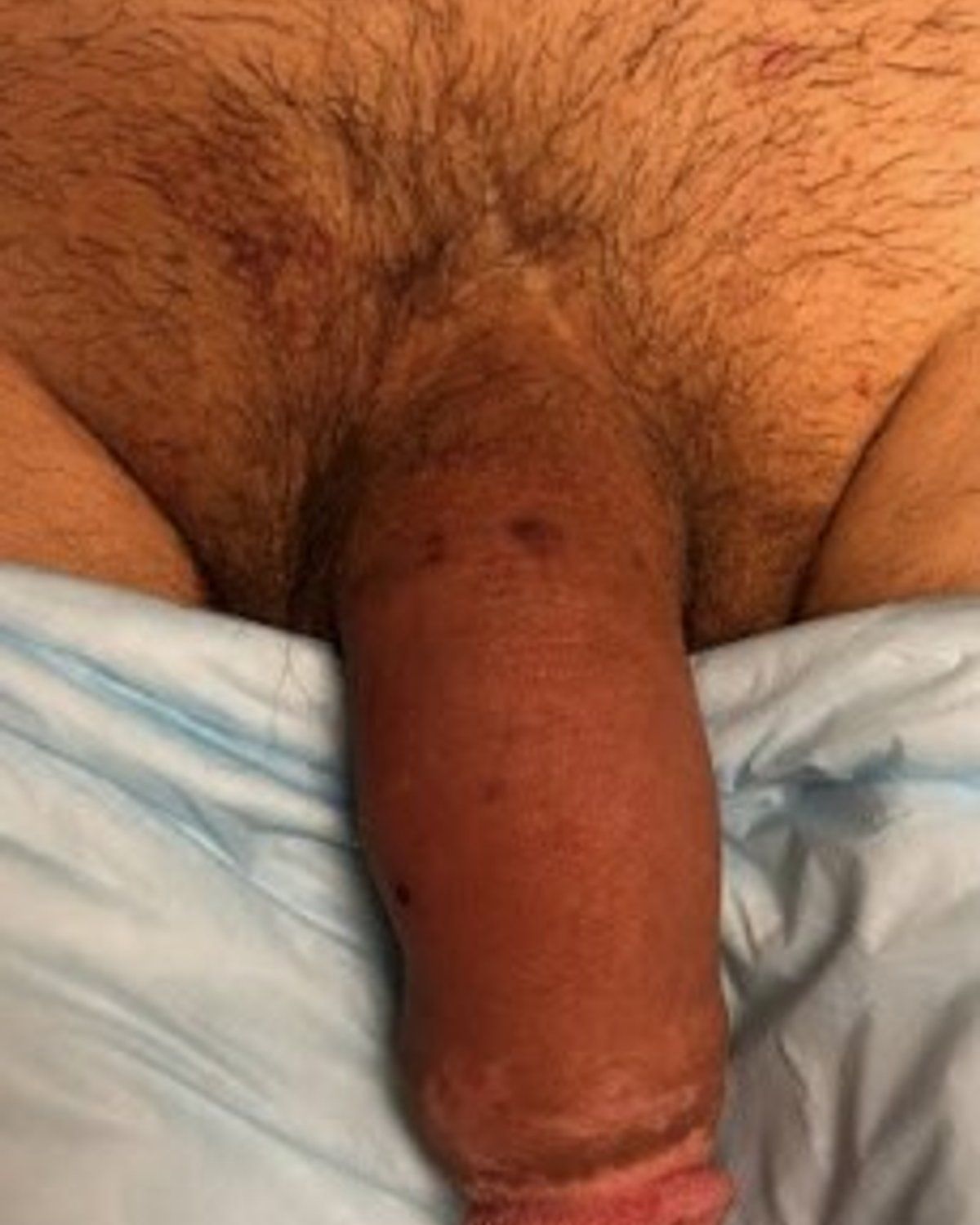 Penis Filler after