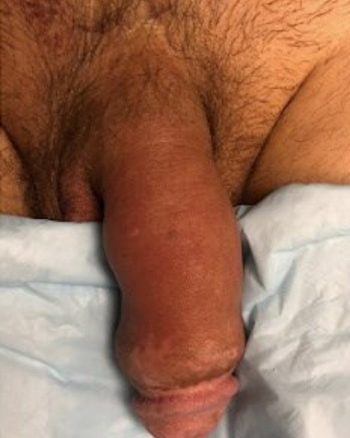 Penis Filler before