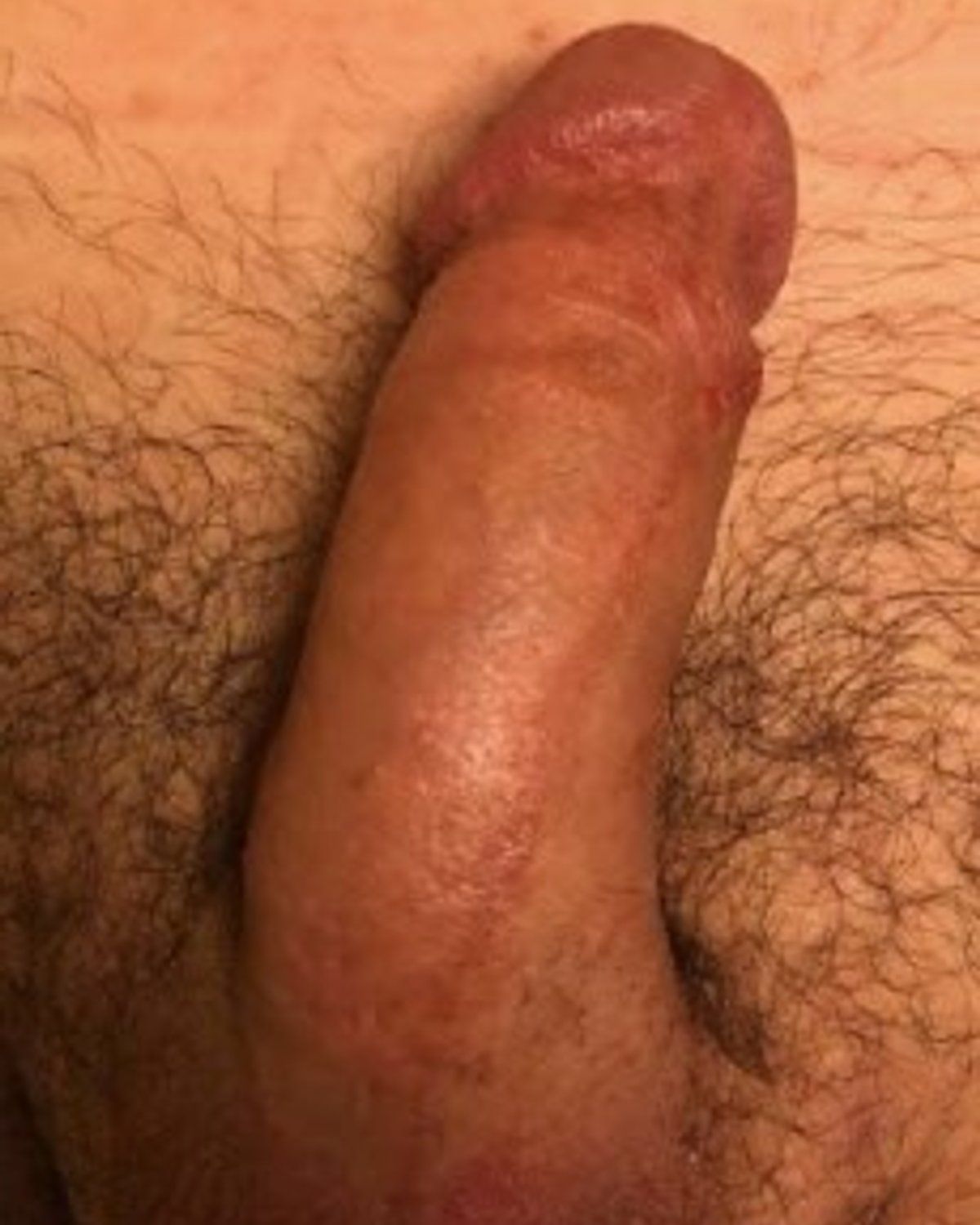 Penis Filler after