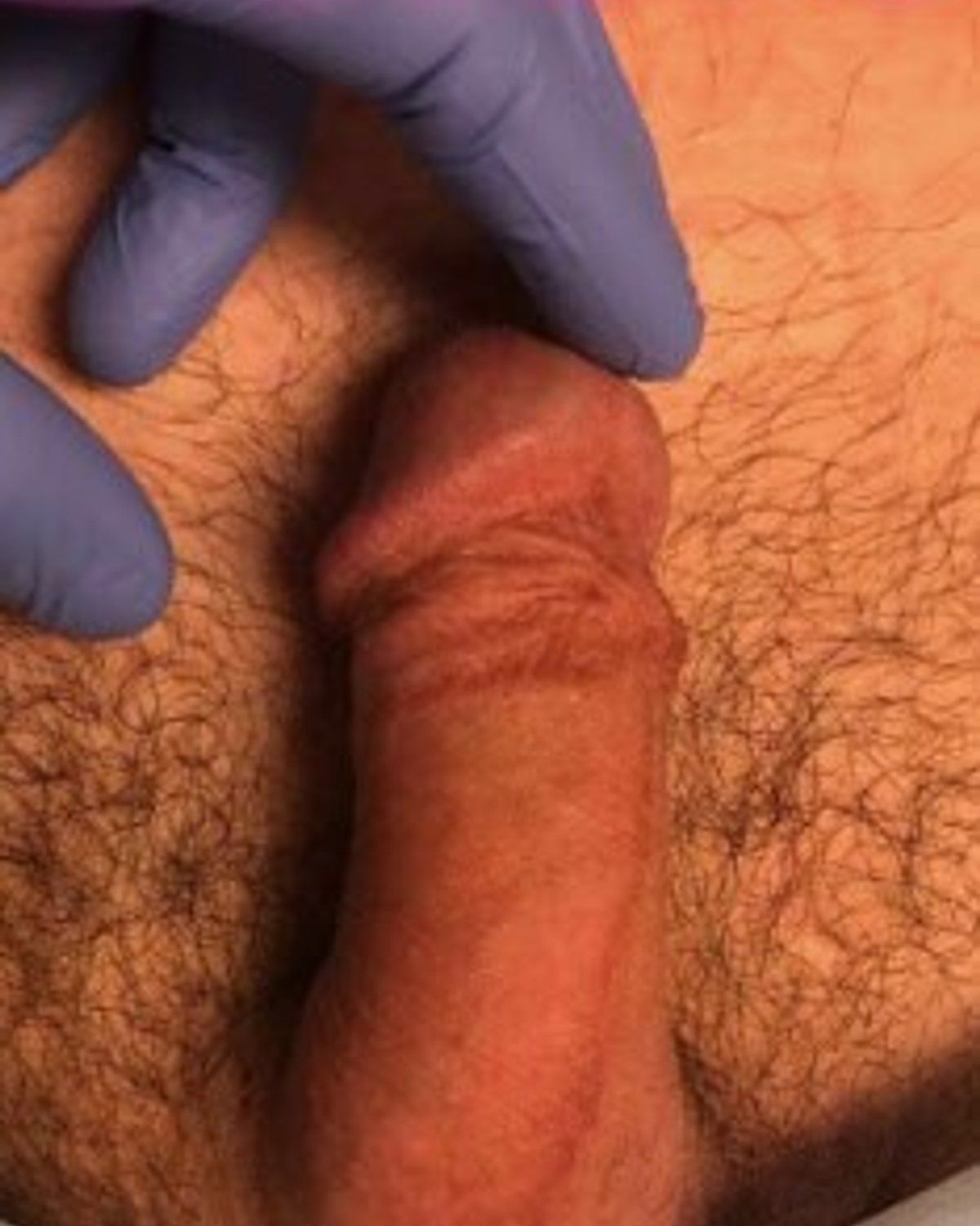 Penis Filler before