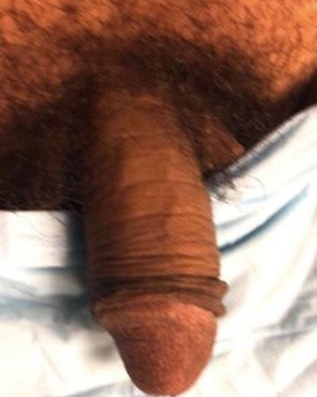 Penis Filler before