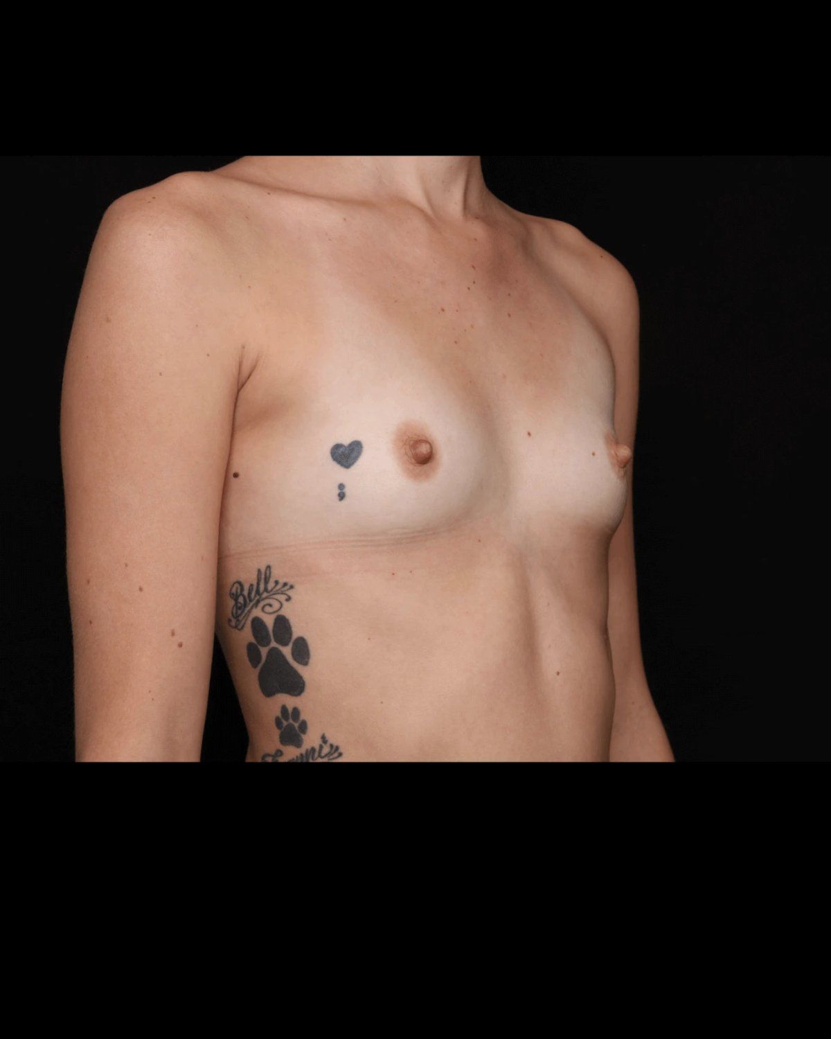 Breast Augmentation with Implants before