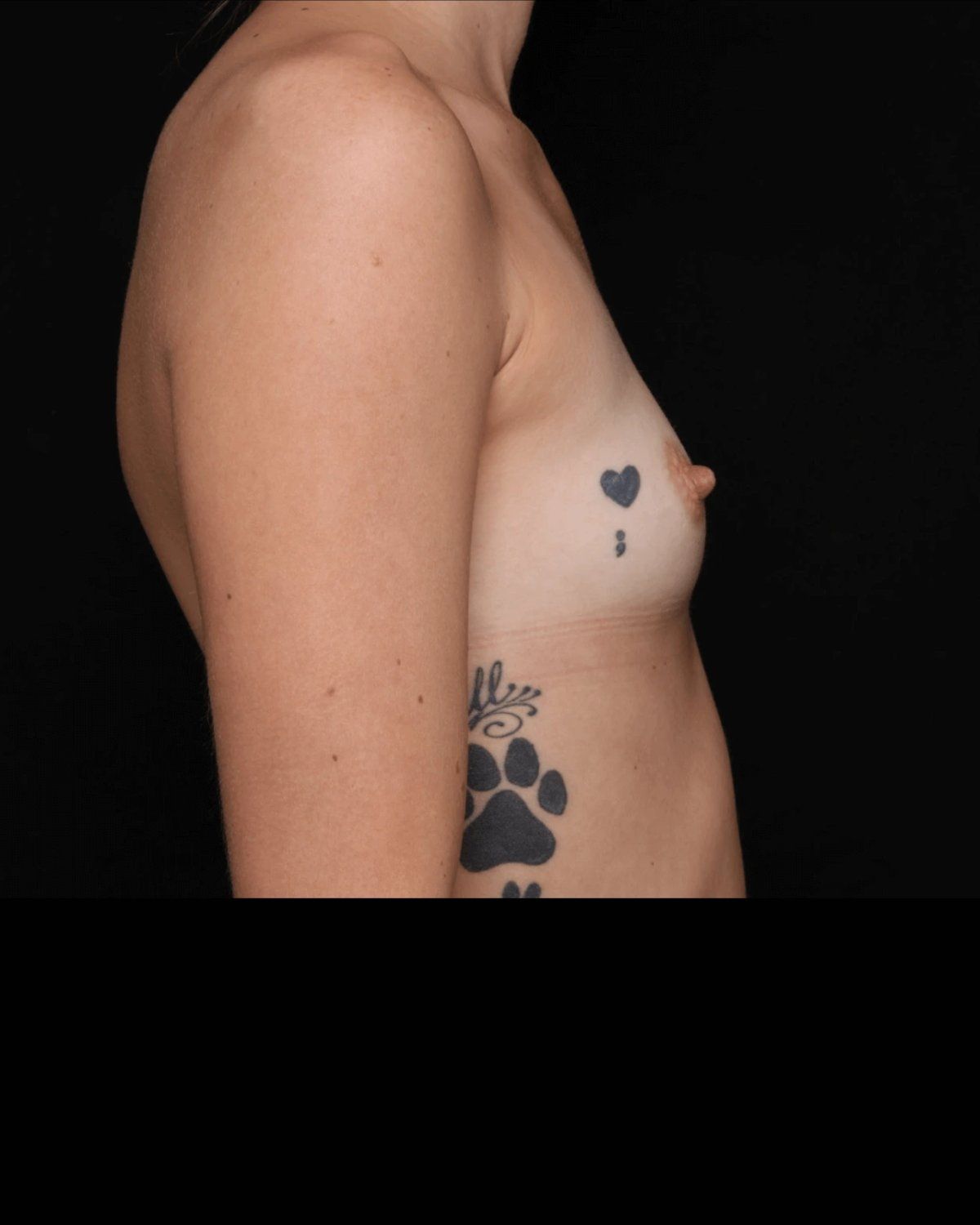 Breast Augmentation with Implants — Right Profile view, before