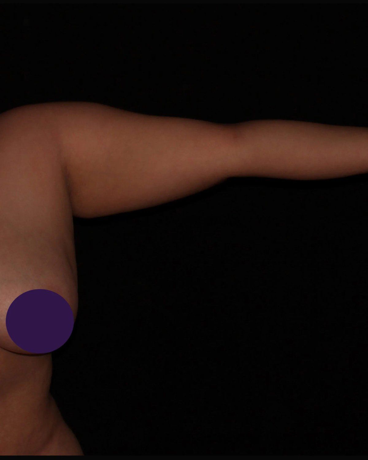 Arm Lift before