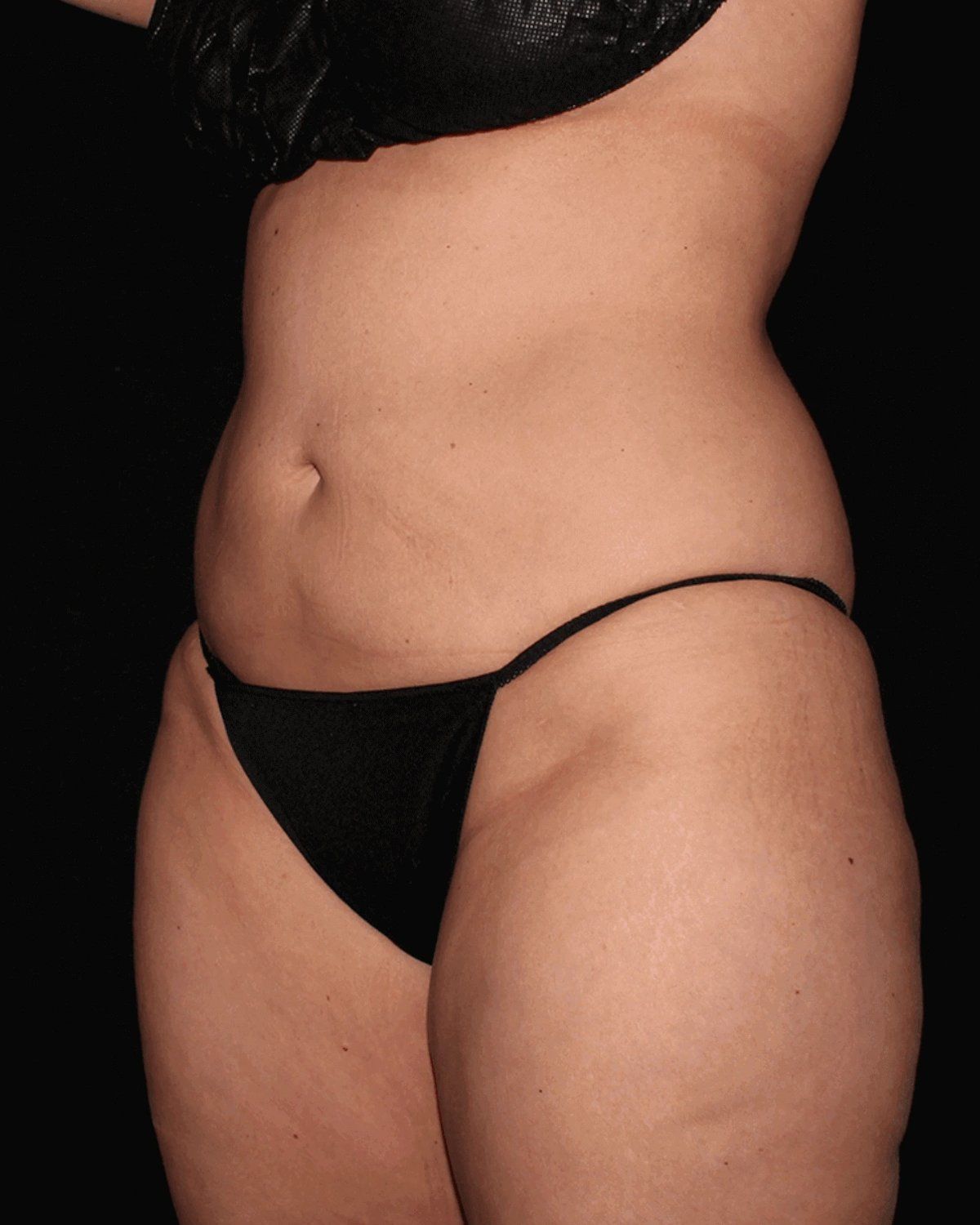 Vaser Lipo 360 (5L Max) before