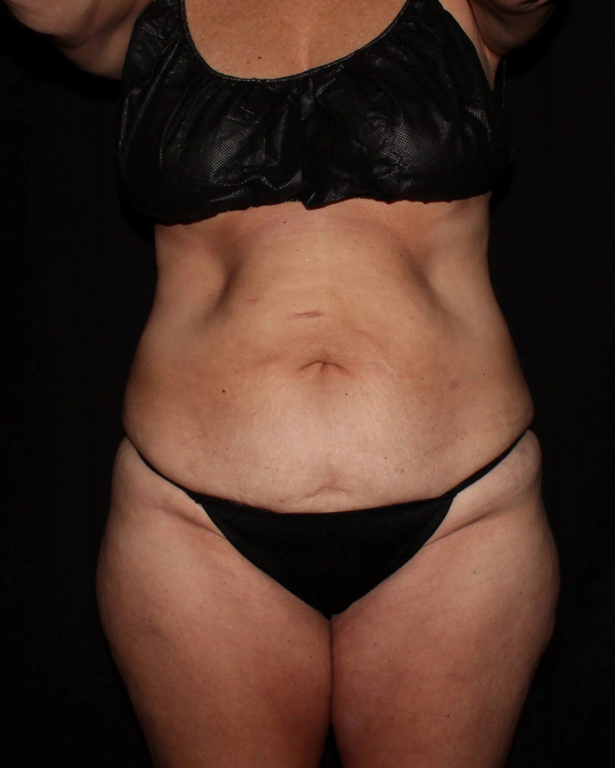Tummy Tuck before
