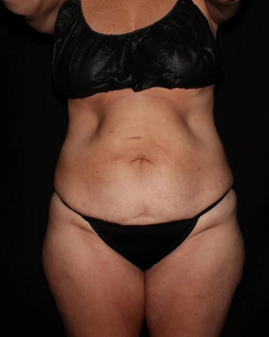 Before Tummy Tuck