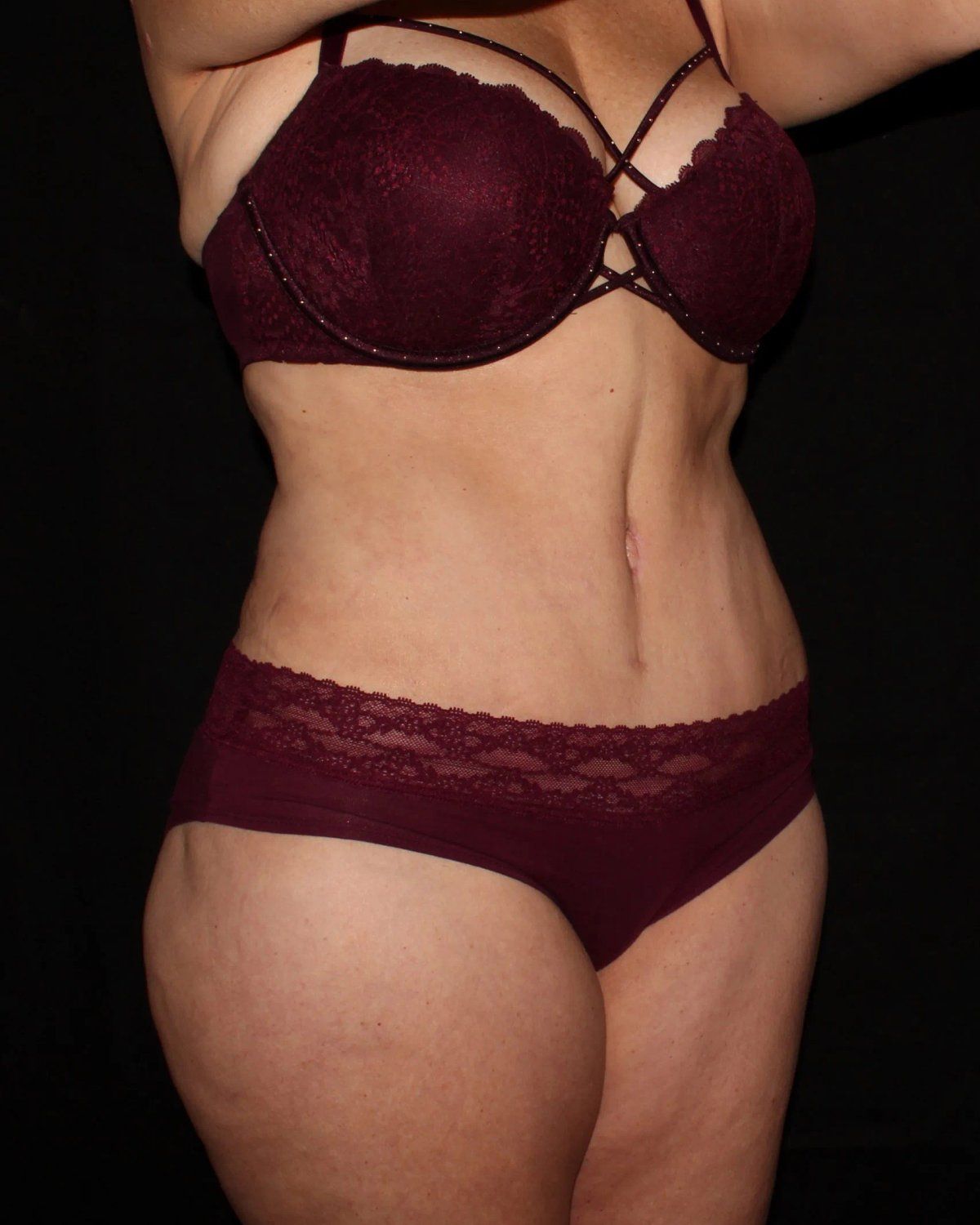 Tummy Tuck — Oblique Right view, after
