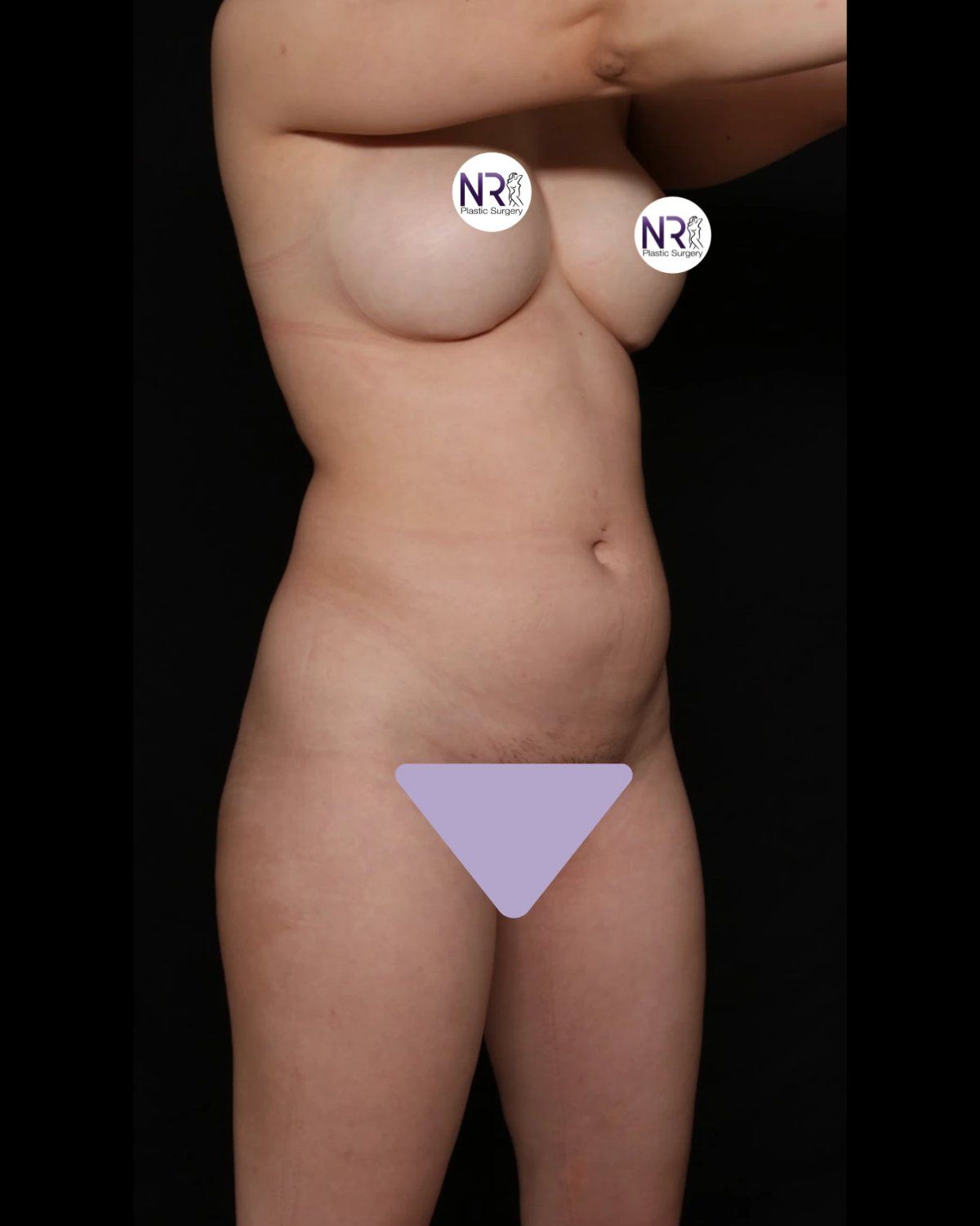 Front Liposuction (5L) (Same As Lipo360) before