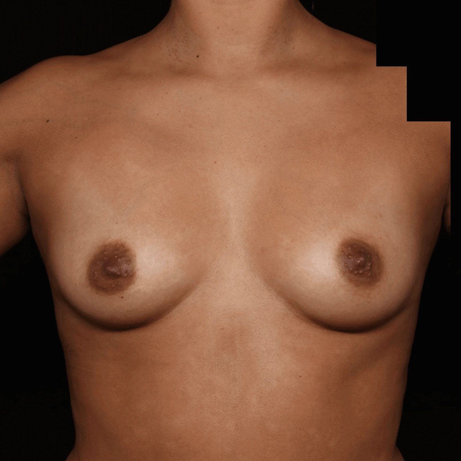 Breast Augmentation with Implants before