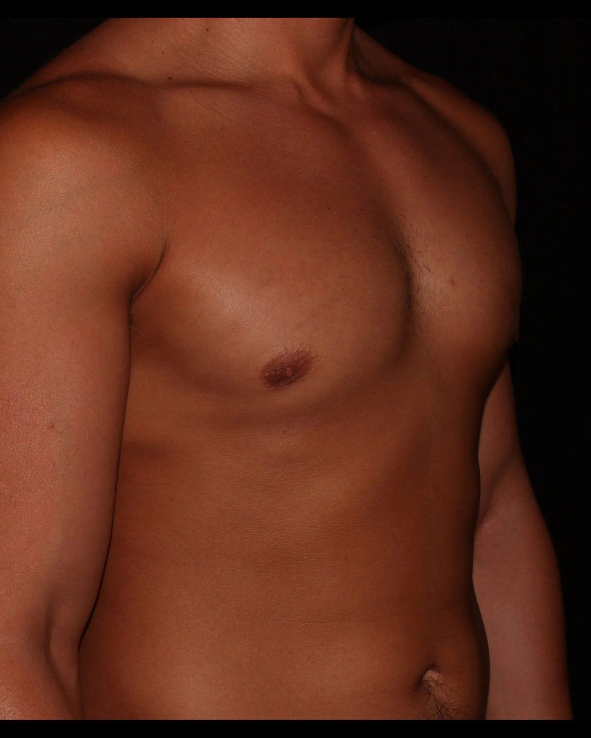 One-Stitch Gynecomastia after