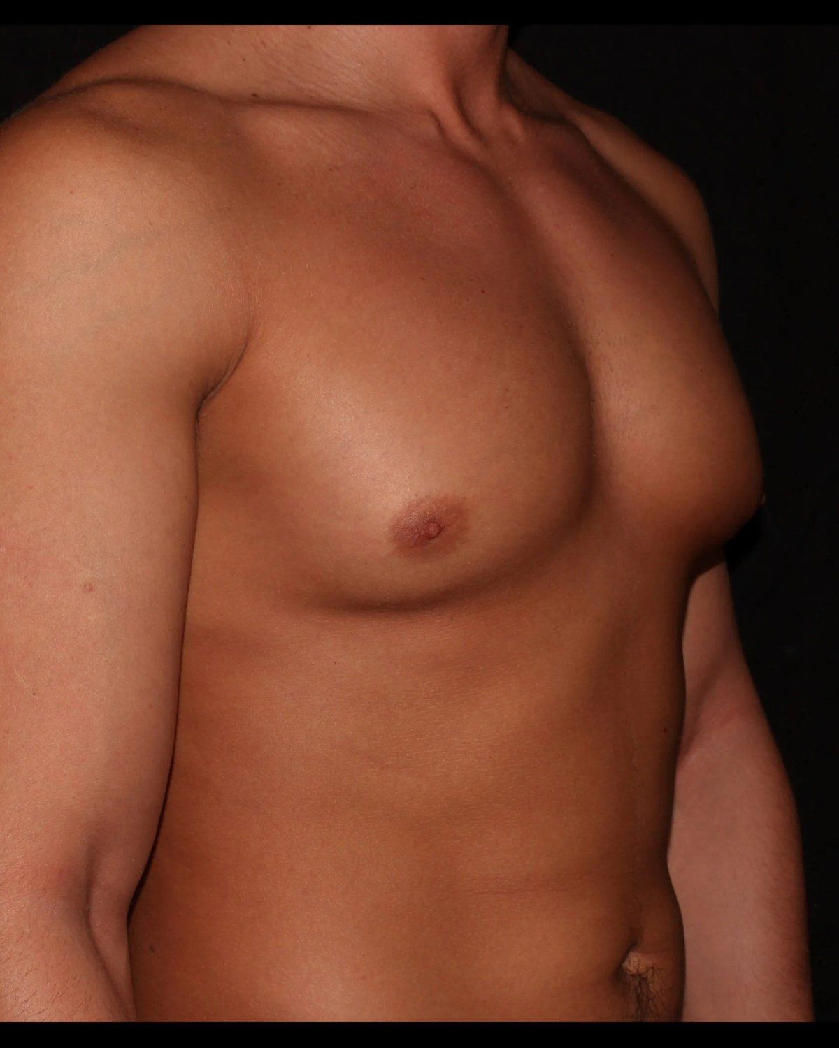 One-Stitch Gynecomastia before
