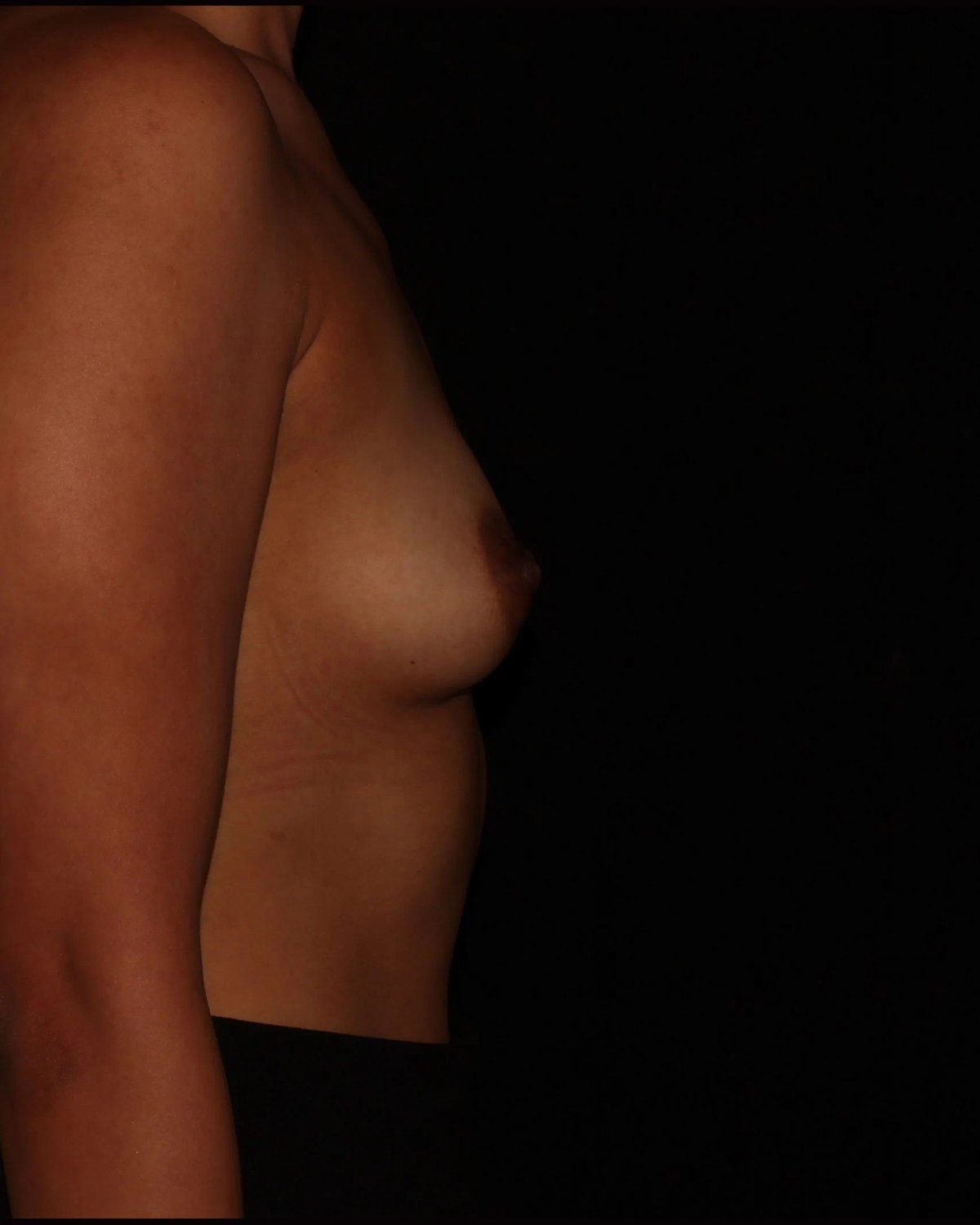 Breast Augmentation with Implants — Right Profile view, before