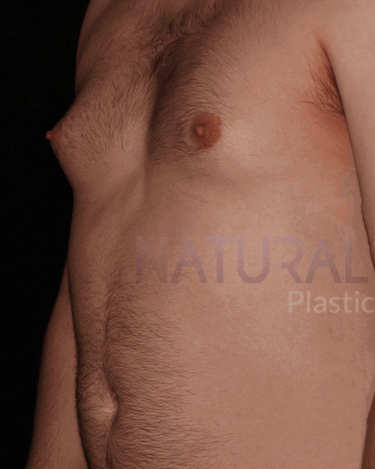 One-Stitch Gynecomastia before