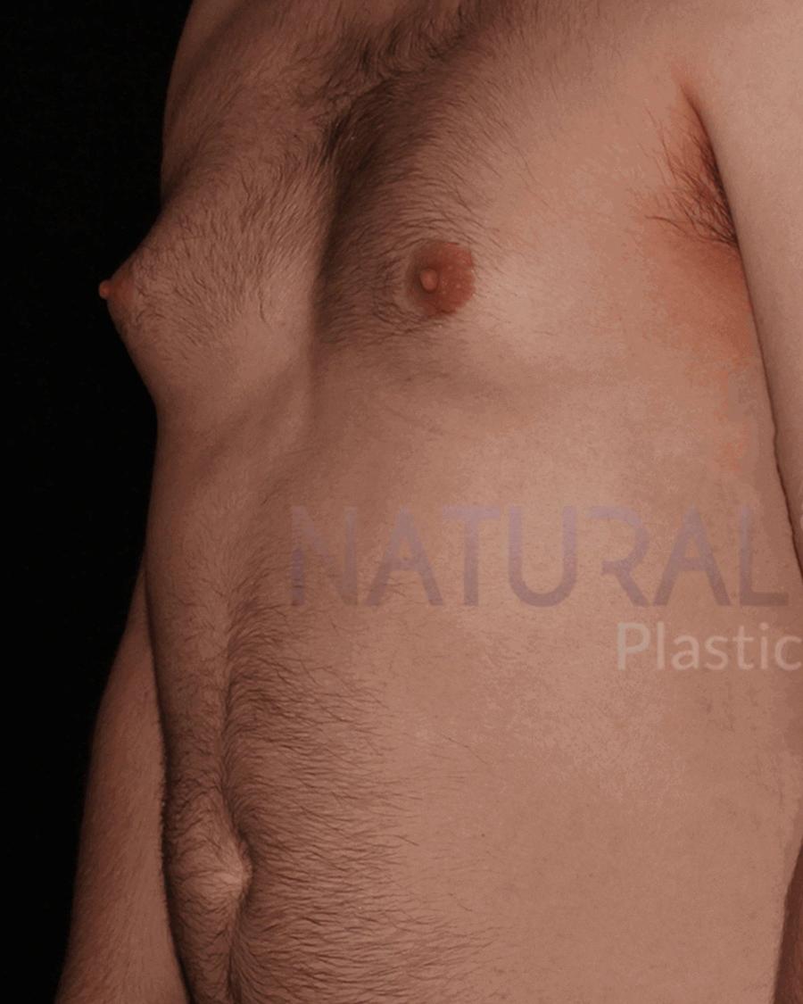 Before One-Stitch Gynecomastia