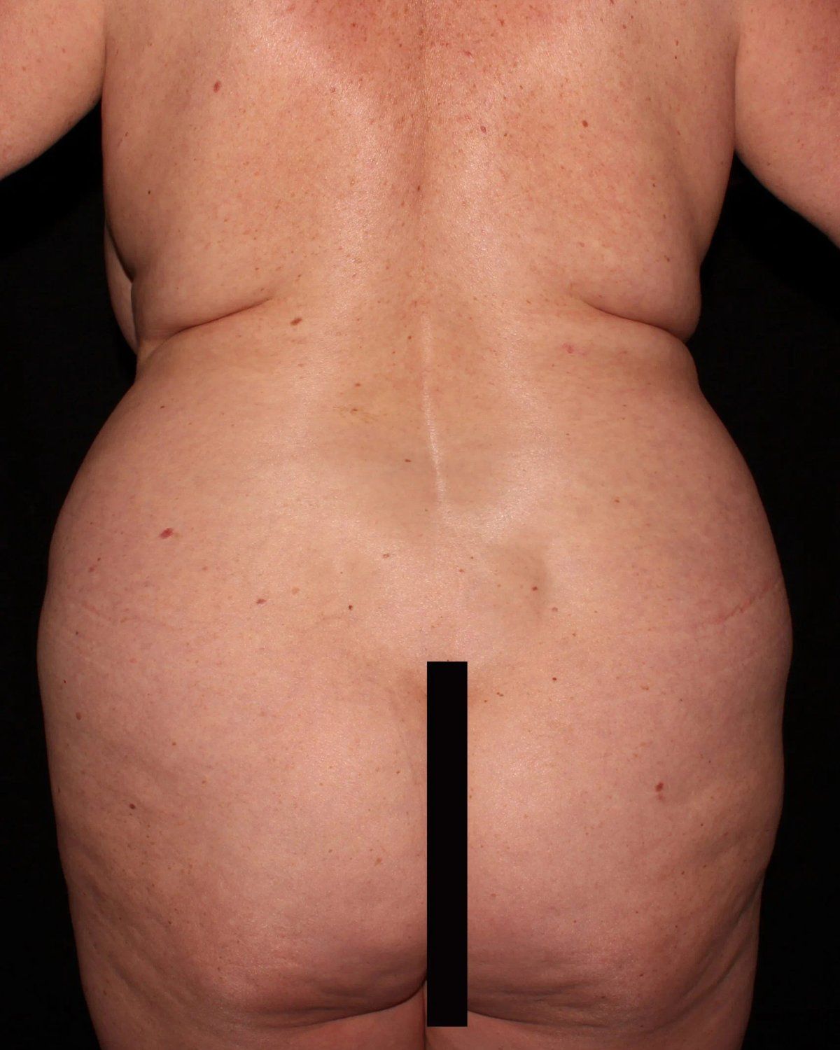 Breast Augmentation with Implants — Back view, before