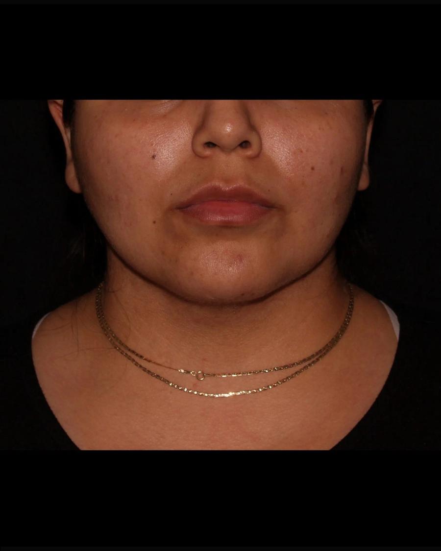 After Buccal Fat Pad Removal