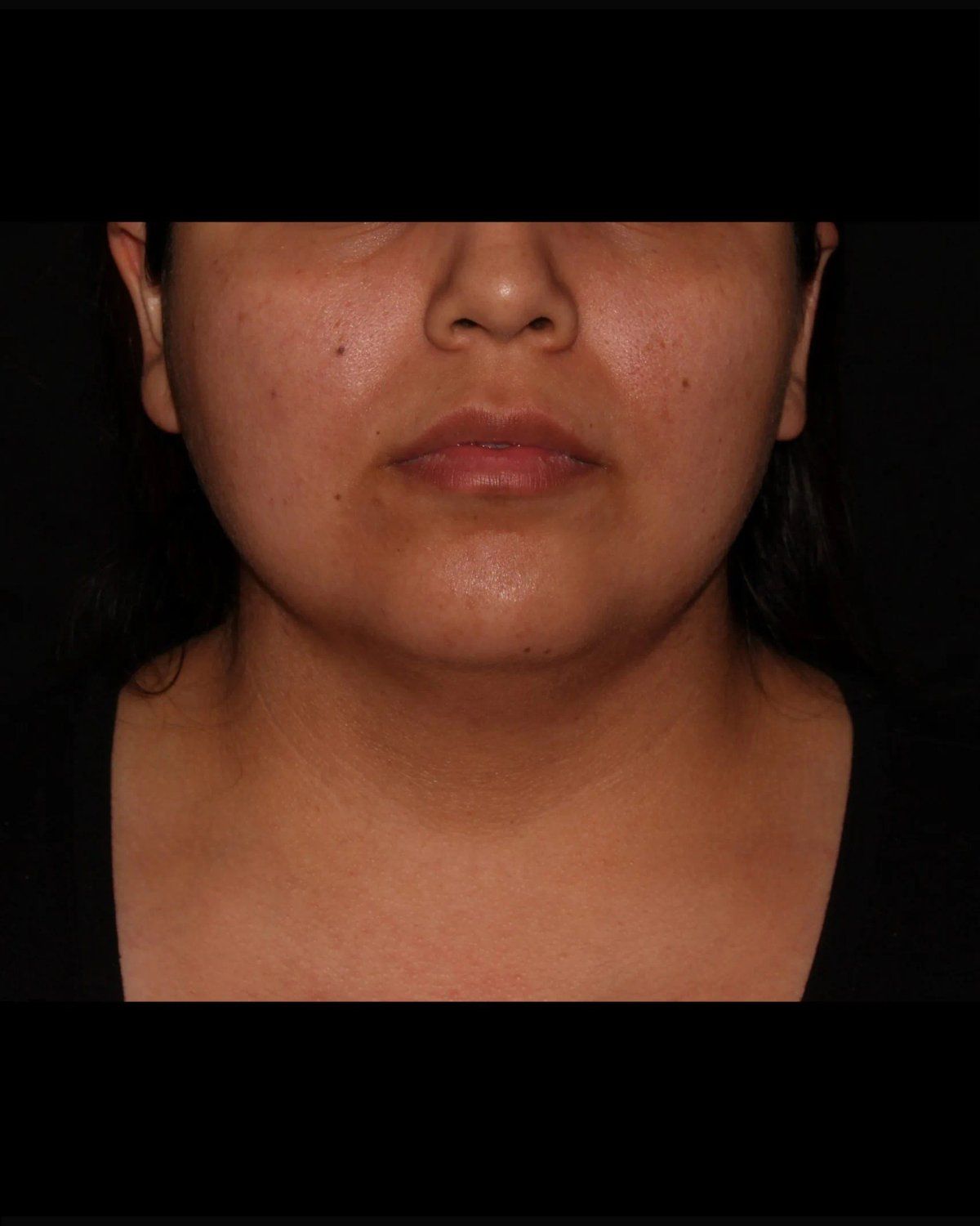 Buccal Fat Pad Removal before