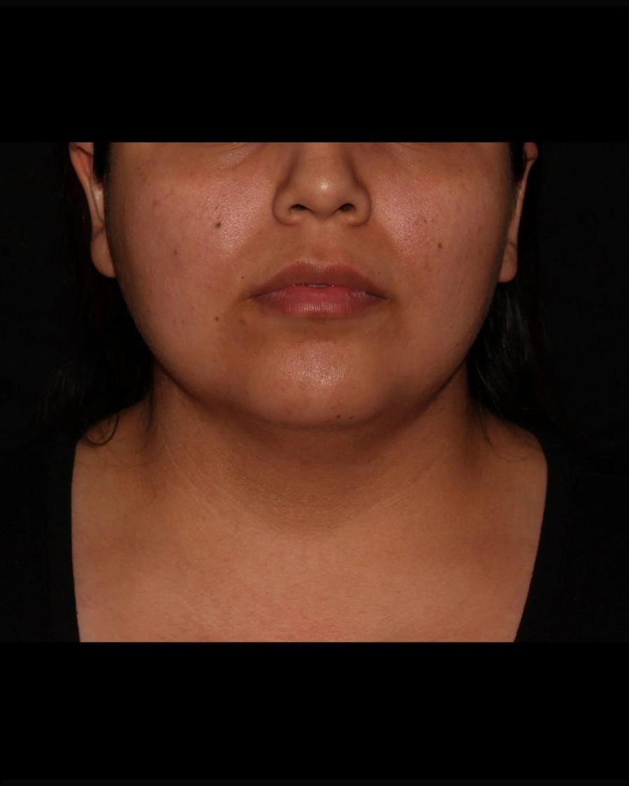Before Buccal Fat Pad Removal