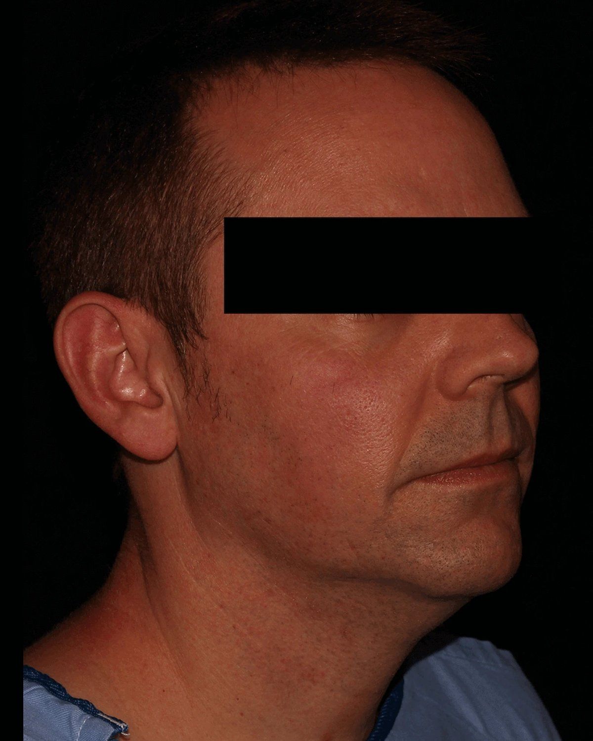 Neck Liposuction w/ Magic Tight before