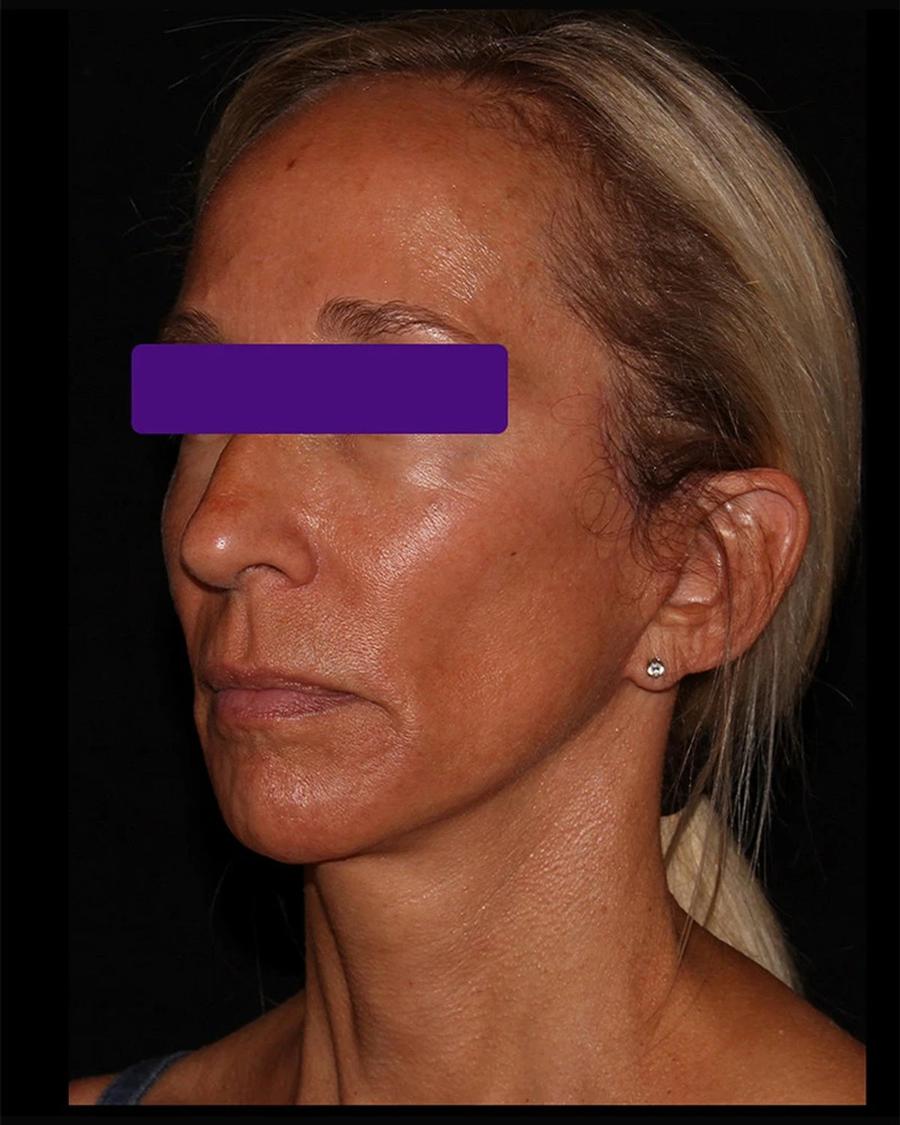After Facelift (neck lift included)
