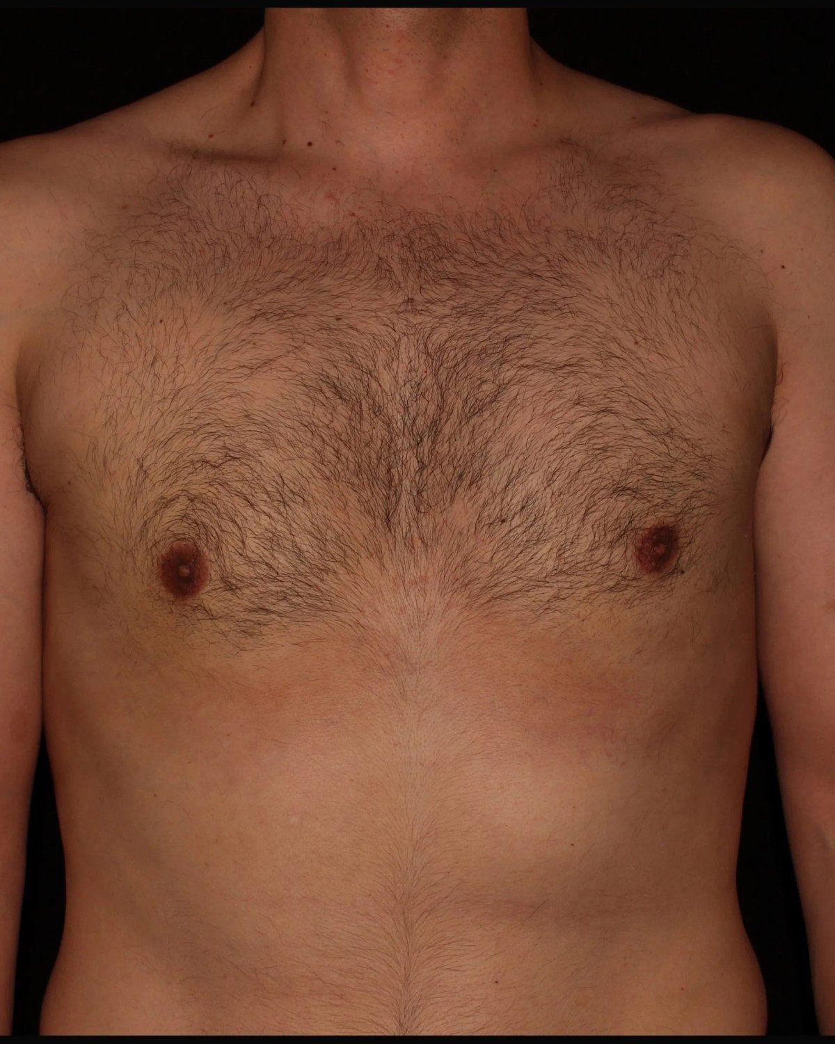 One-Stitch Gynecomastia after