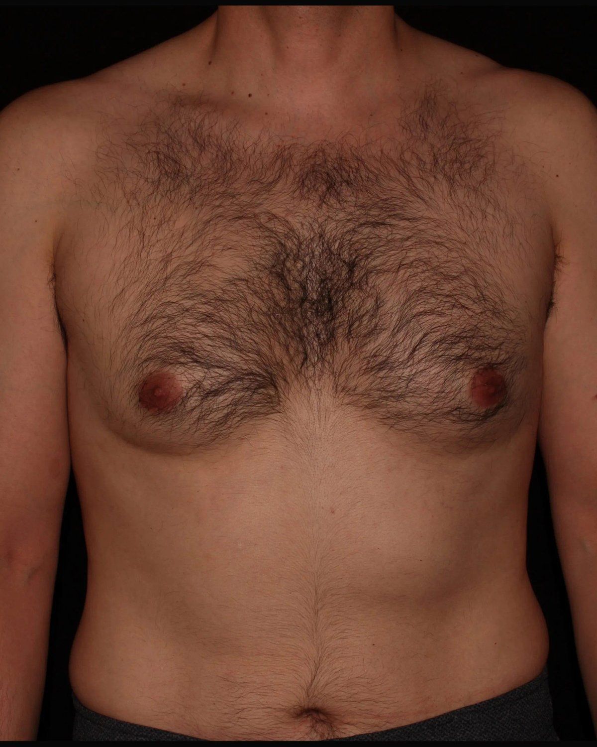 One-Stitch Gynecomastia before