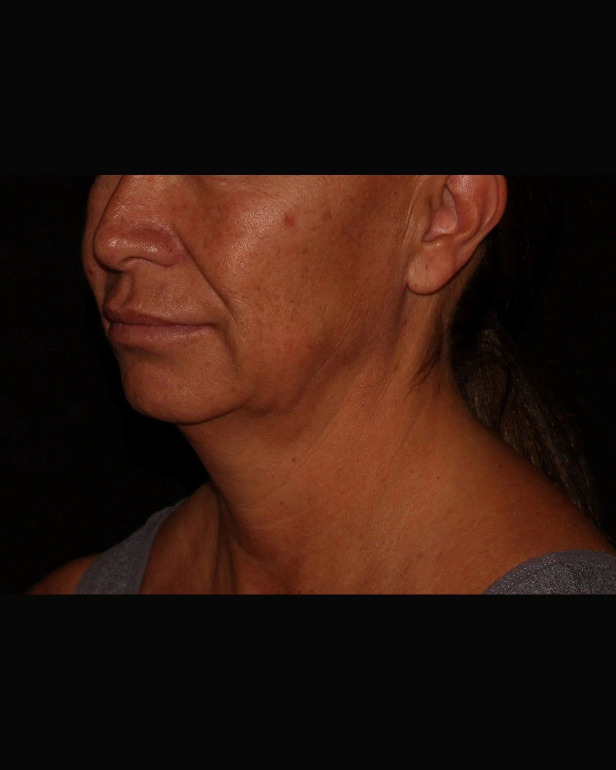 Neck Liposuction w/ Magic Tight before