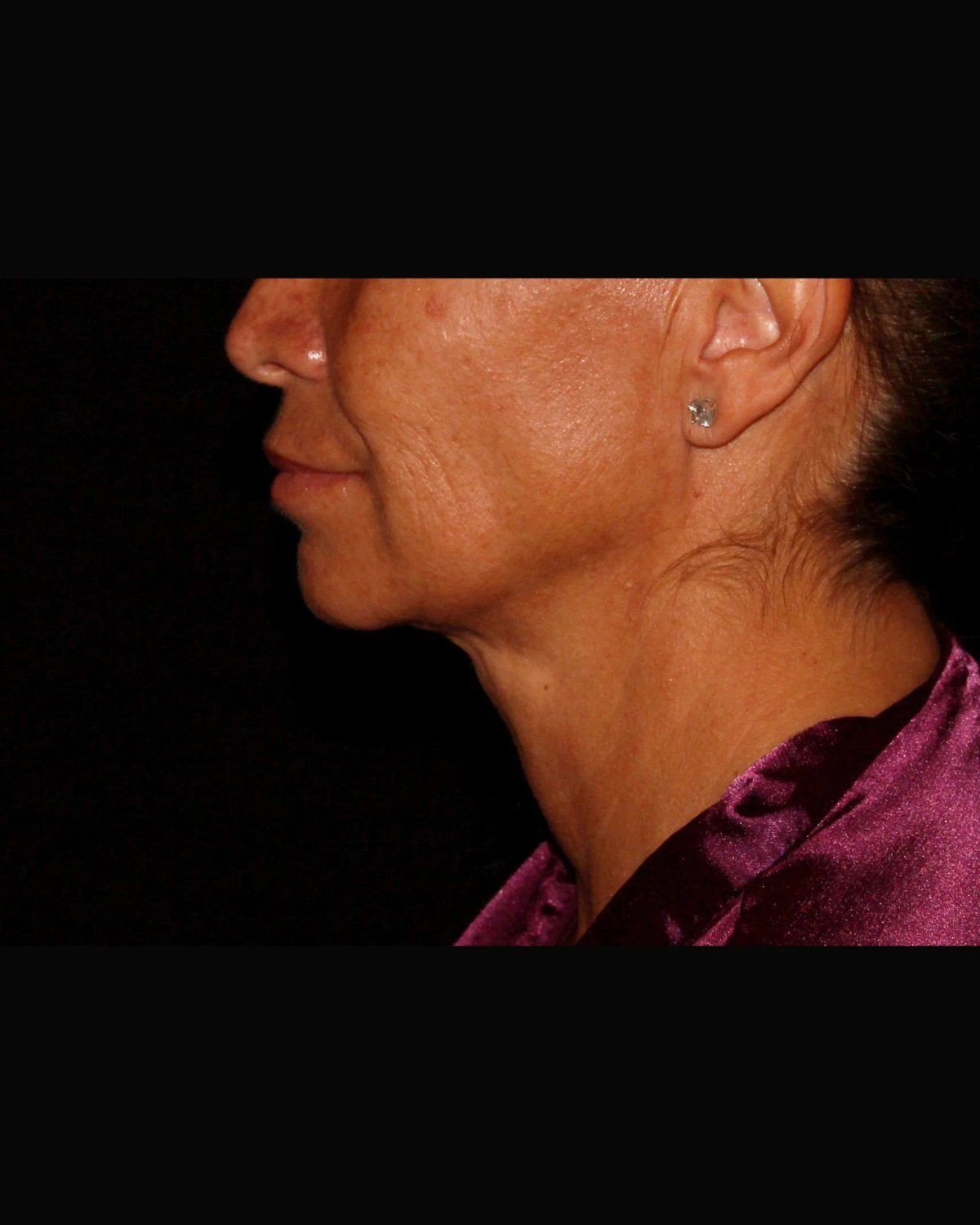 Neck Liposuction w/ Magic Tight — Right Profile view, after