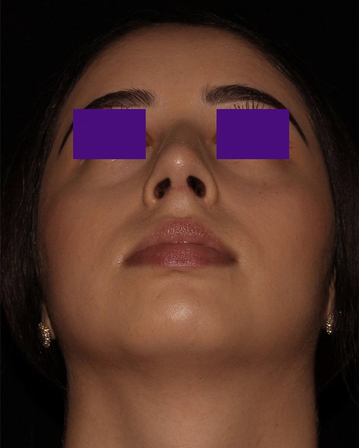 Rhinoplasty after