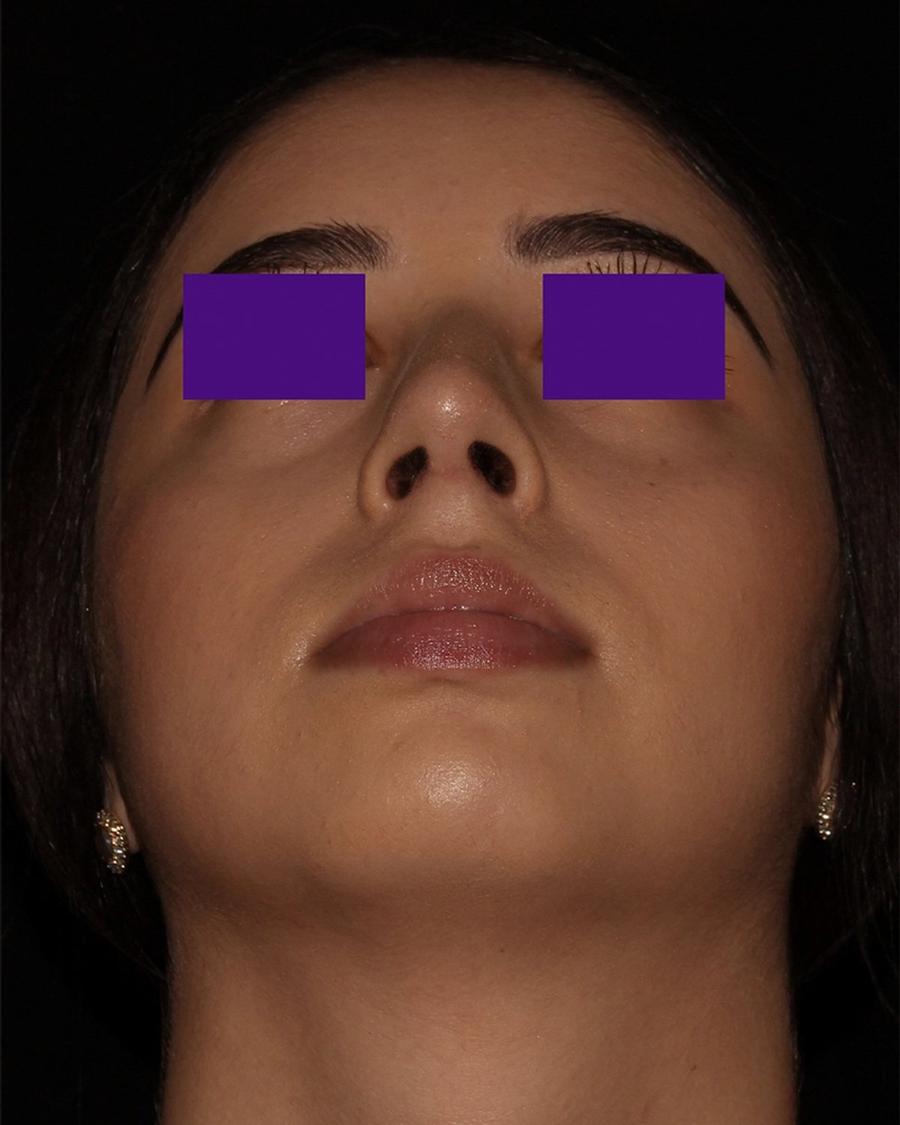 After Rhinoplasty