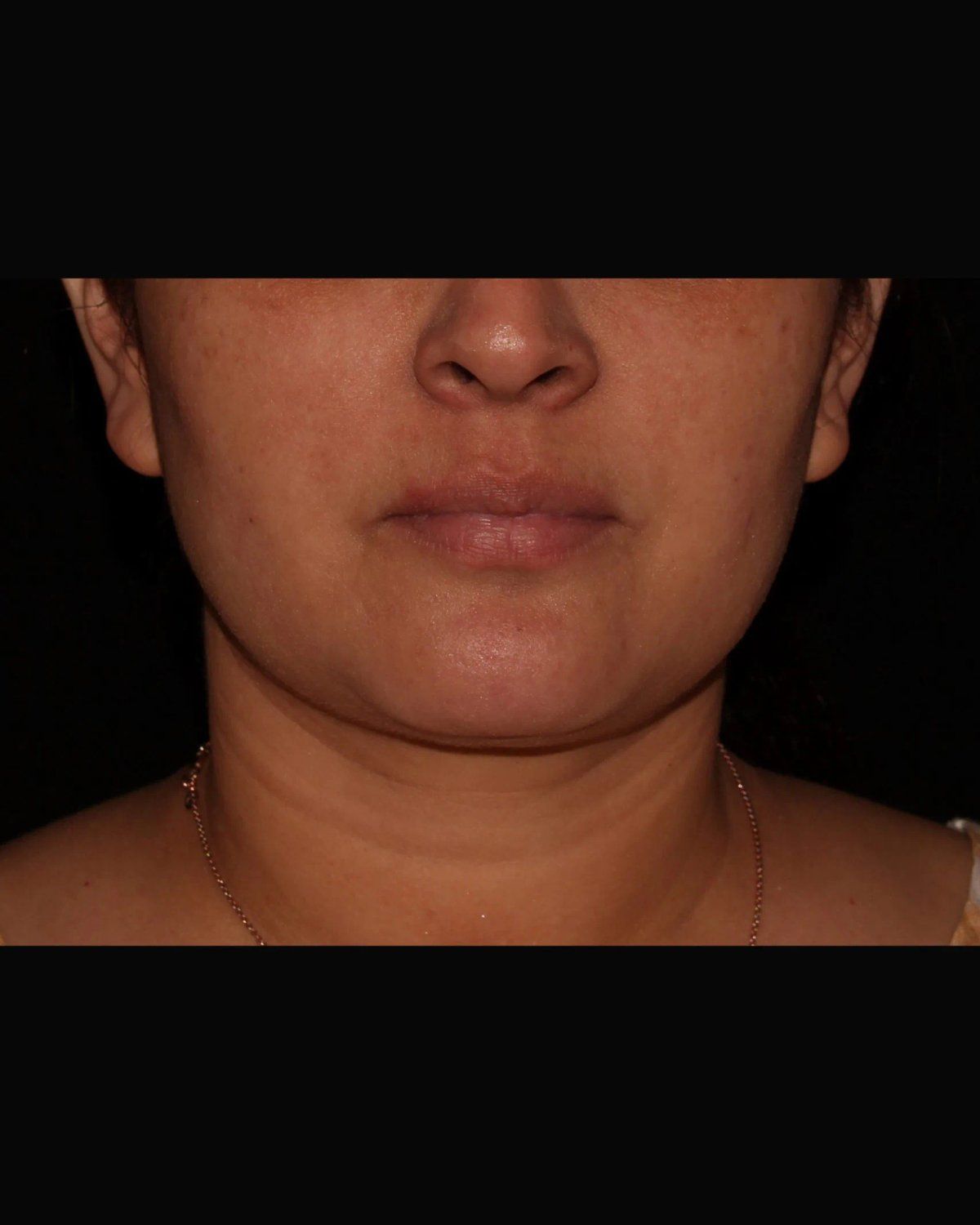 Buccal Fat Pad Removal before