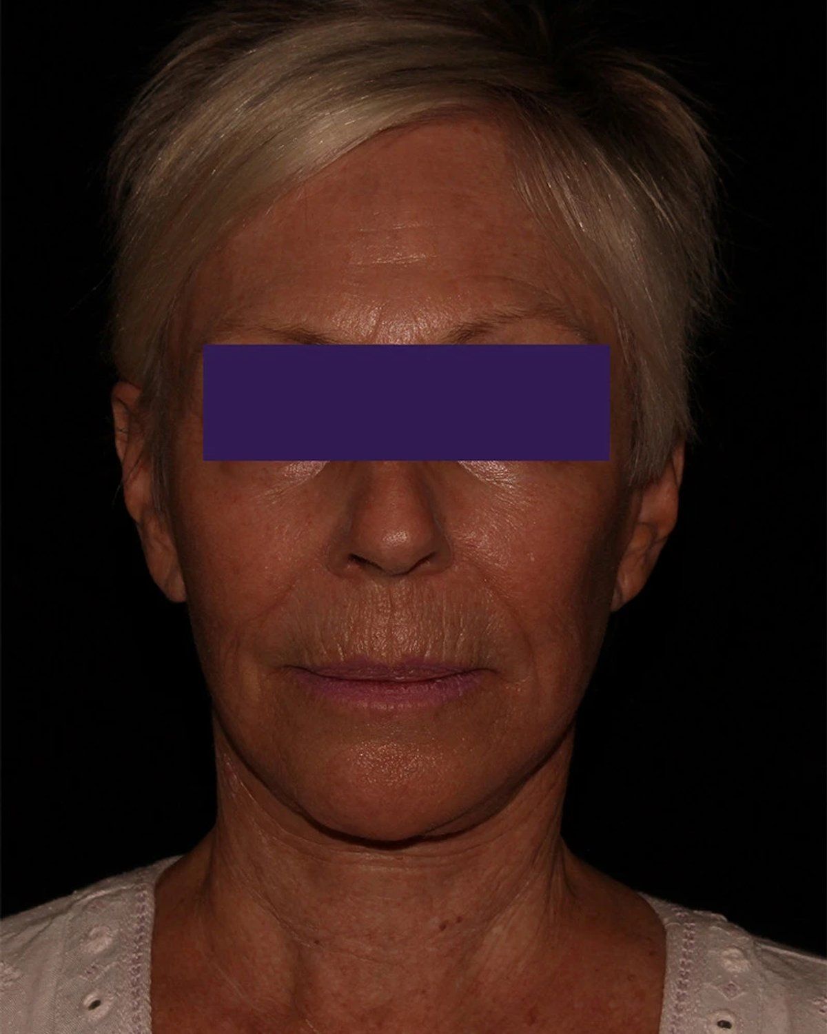 Facelift (neck lift included) after