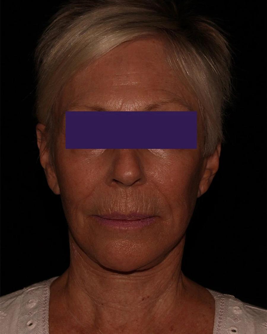 After Facelift (neck lift included)