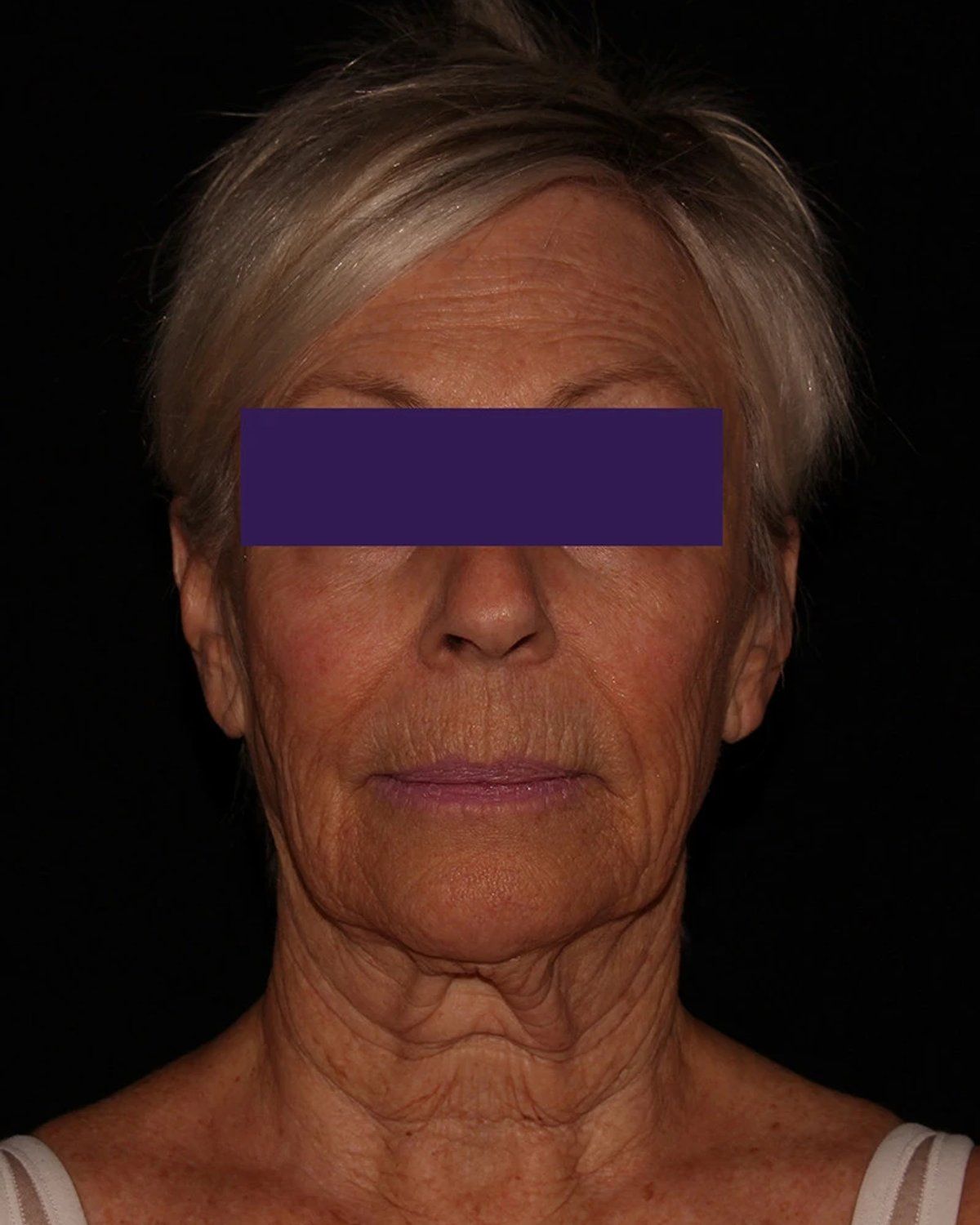 Facelift (neck lift included) before