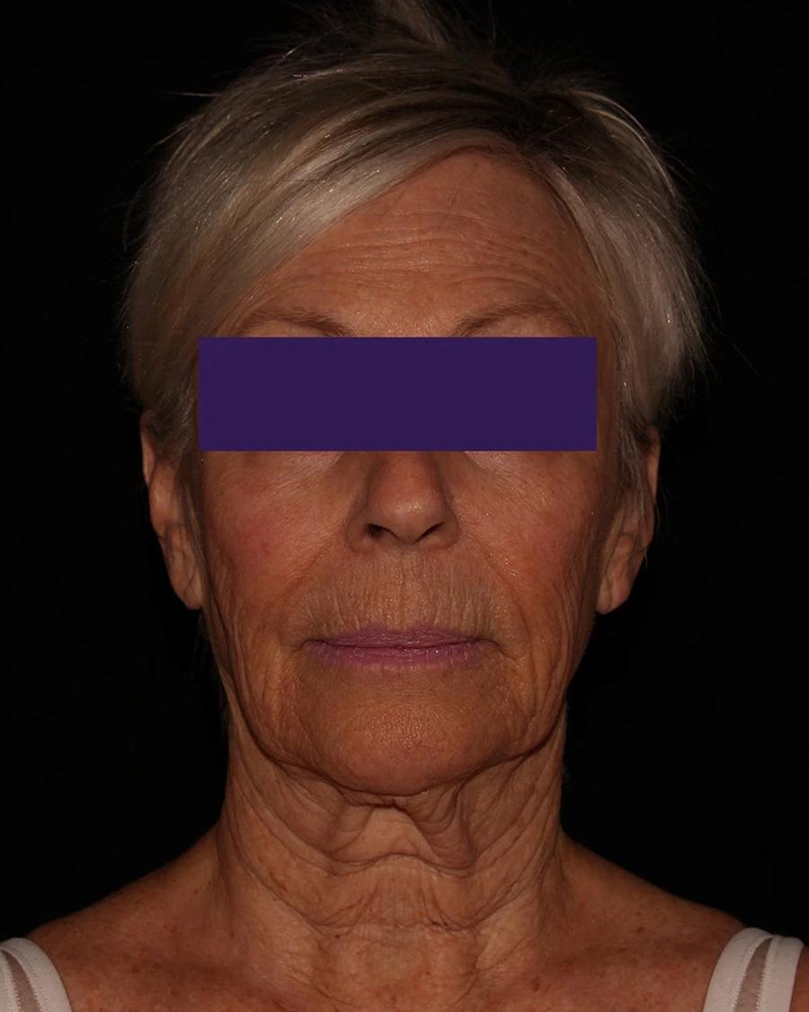 Before Facelift (neck lift included)