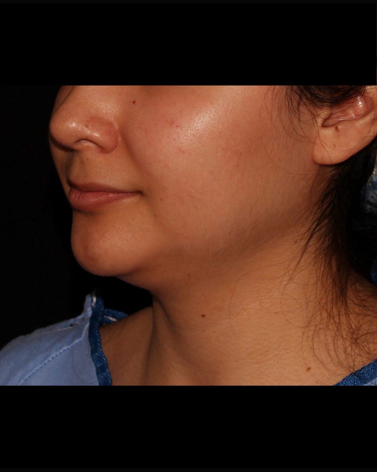 Neck Liposuction w/ Magic Tight before