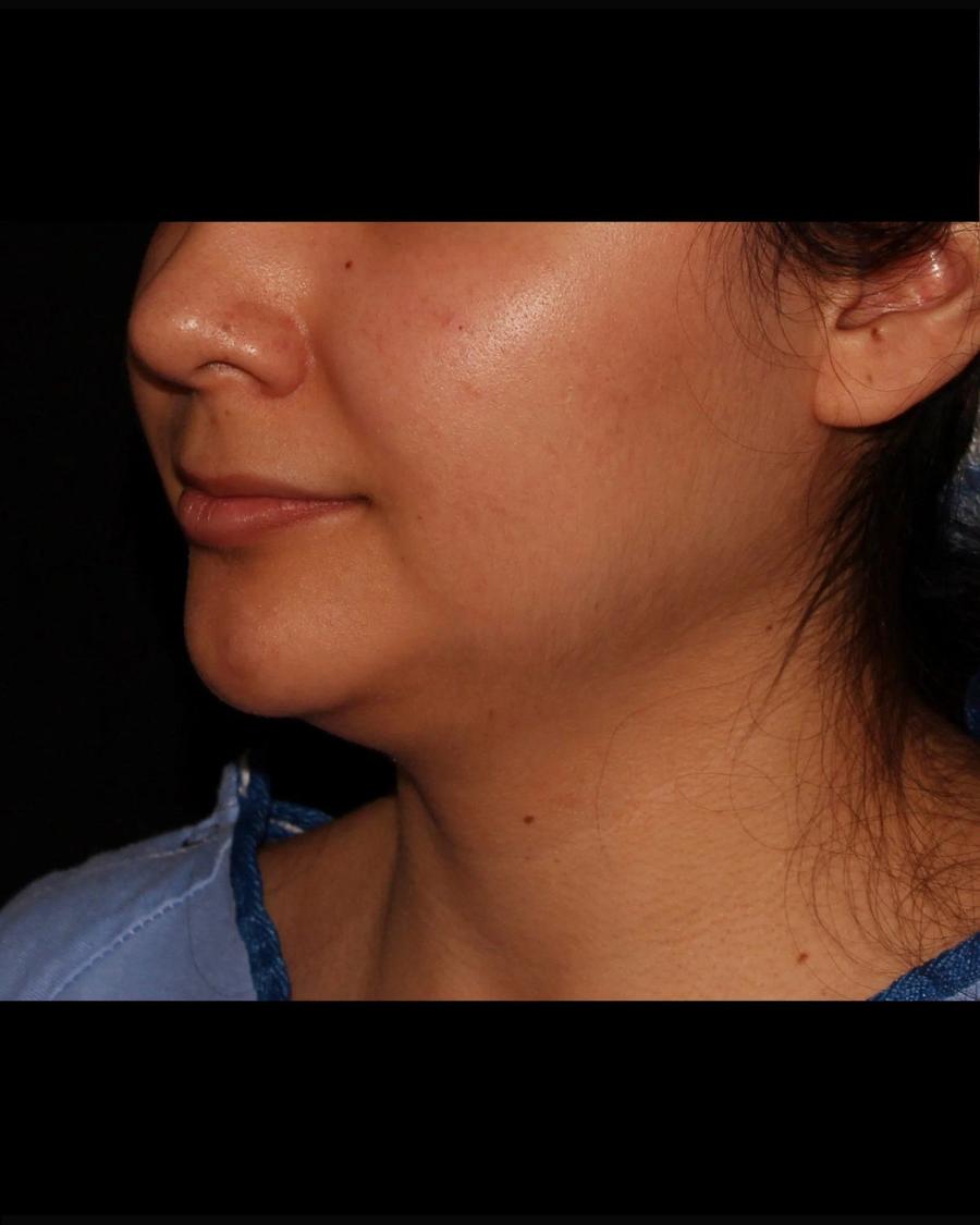 Before Neck Liposuction w/ Magic Tight