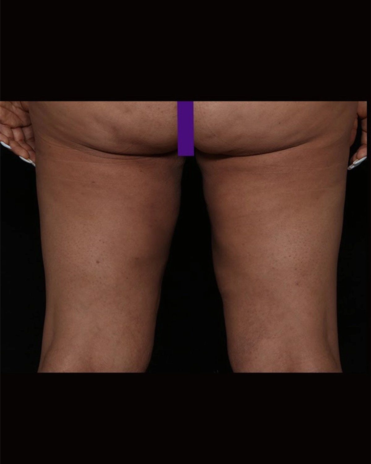 Thigh Lift (Medial) after
