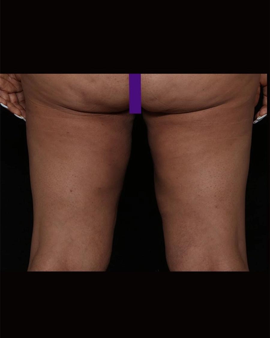 After Thigh Lift (Medial)